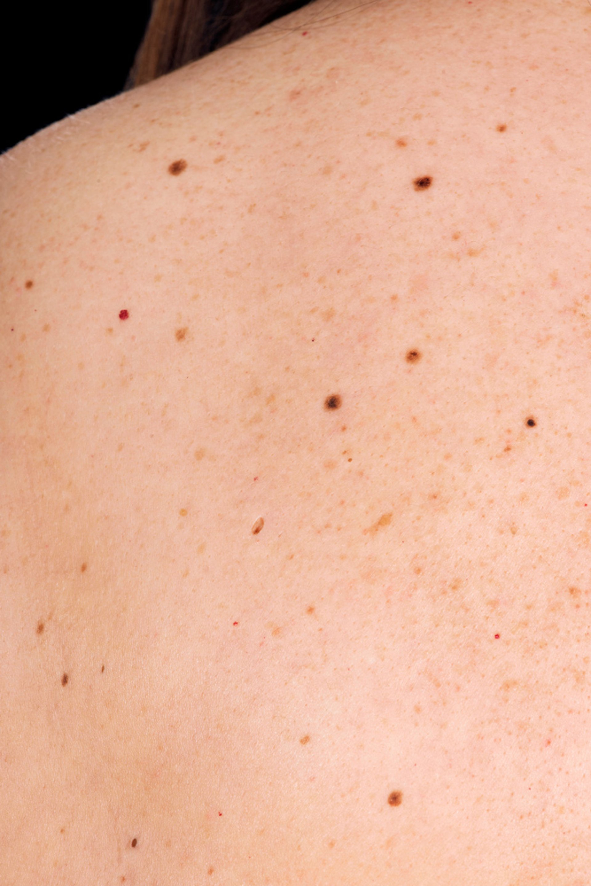 Dysplastic Nevi (Atypical Moles)