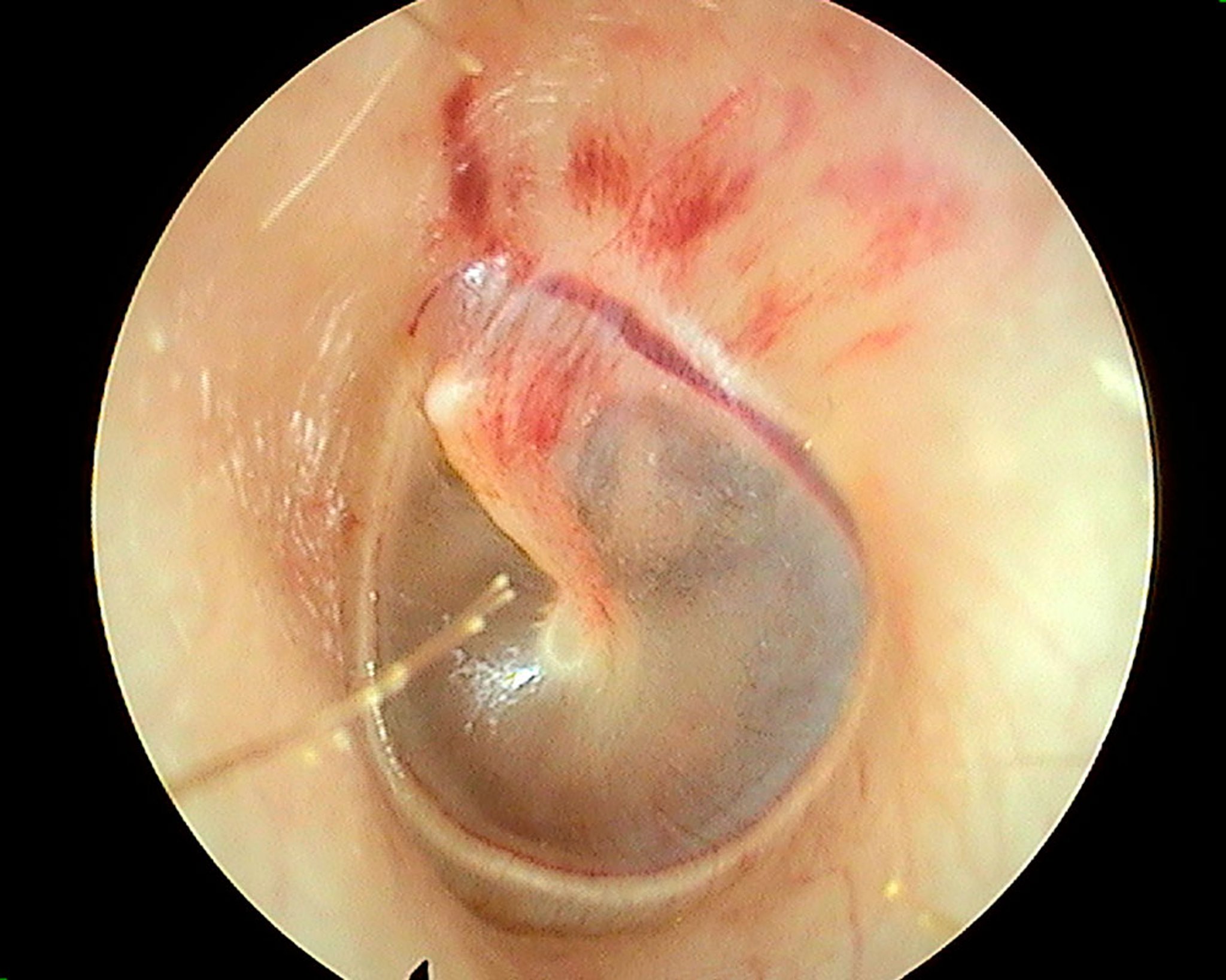 Barotrauma Inside the Ear (Otoscopic View)