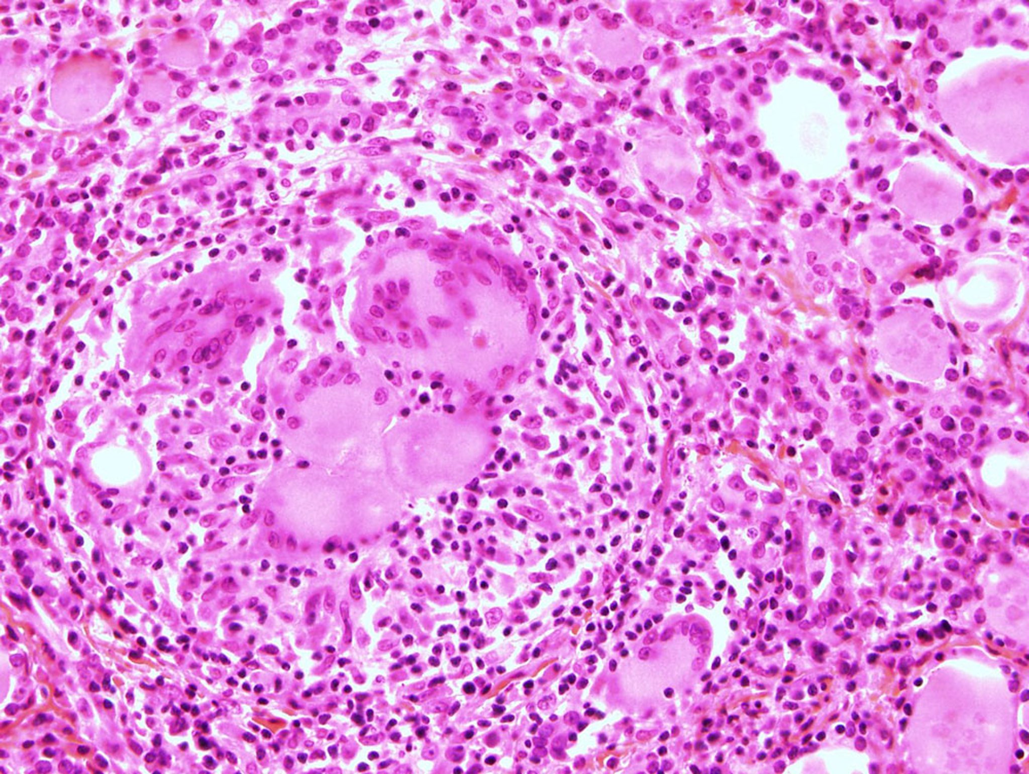 Subacute Granulomatous Thyroiditis