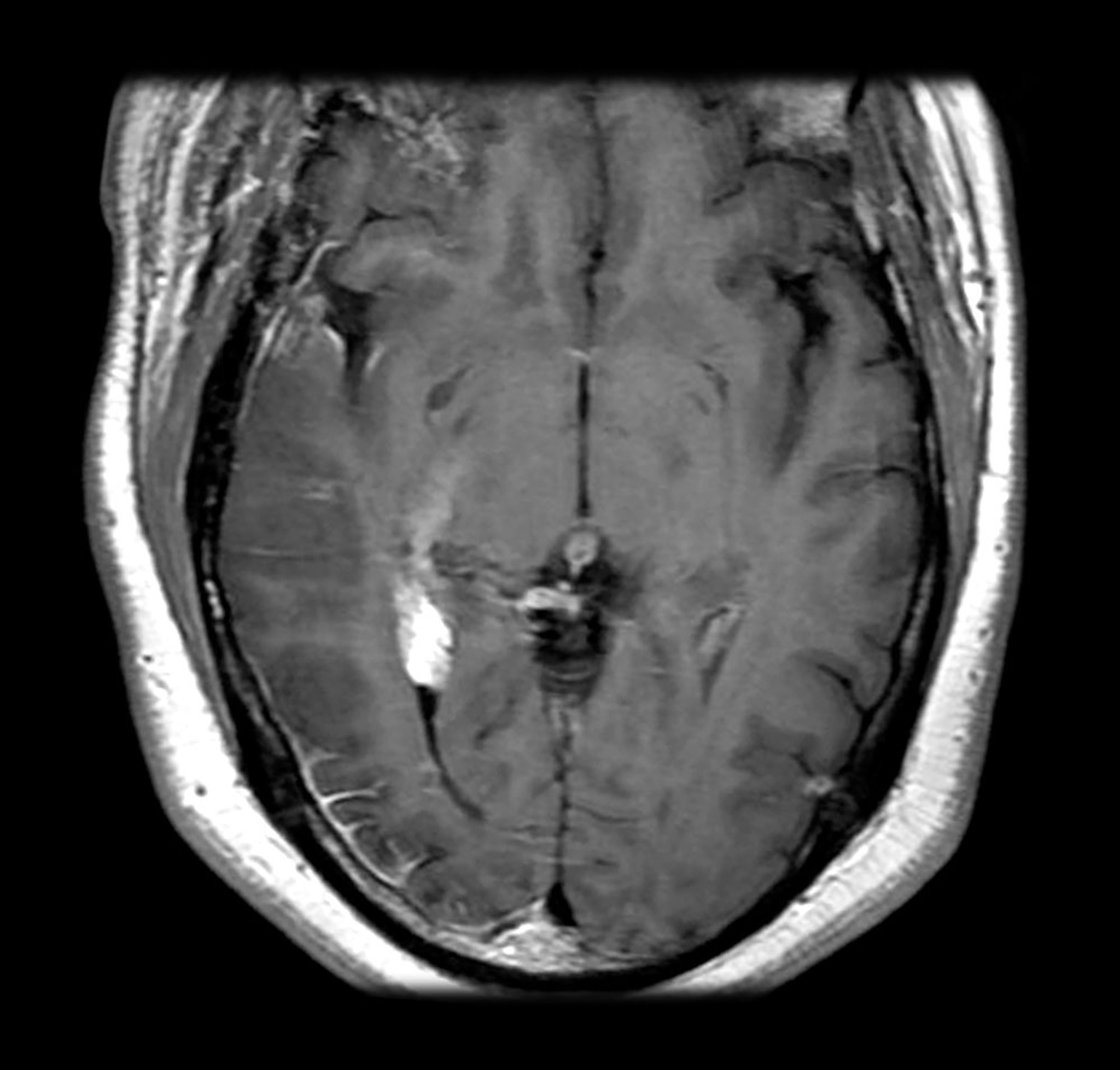 斯特奇-韦伯综合征的皮质血管瘤病（MRI）