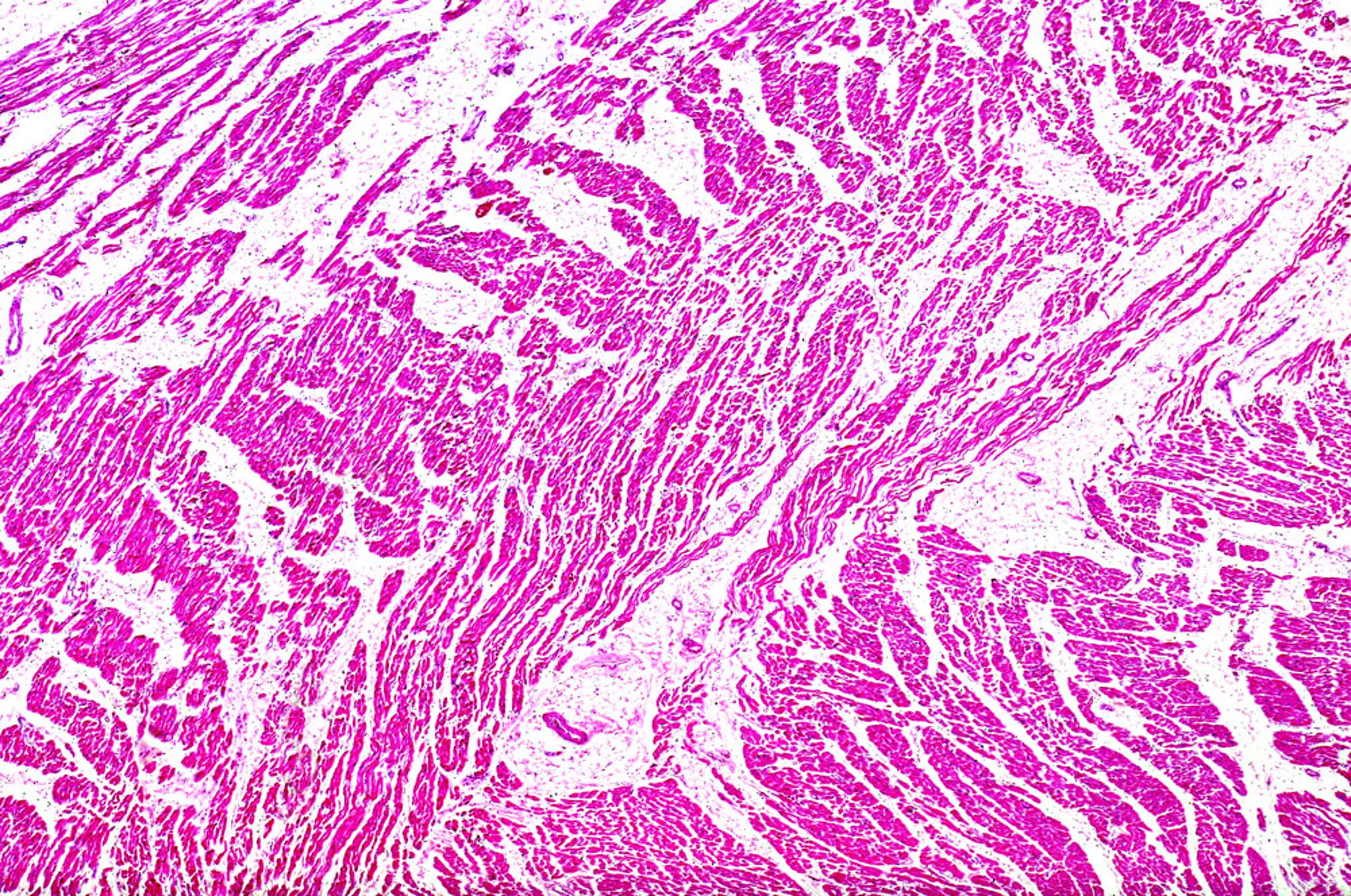 Fatty Infiltration of Myocardium