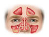 Sinusitis With Polyps