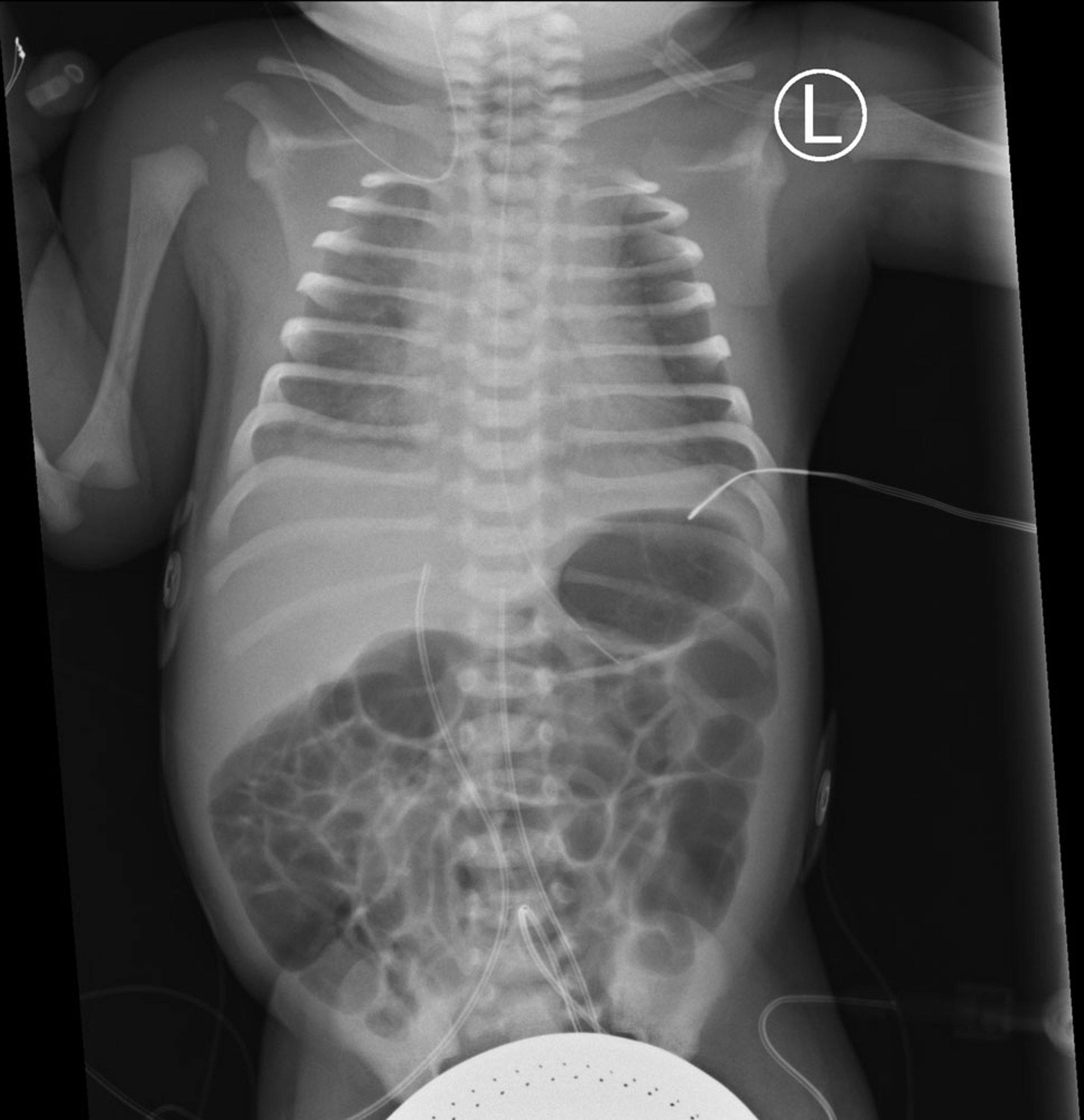 Respiratory Distress Syndrome in a Premature Neonate