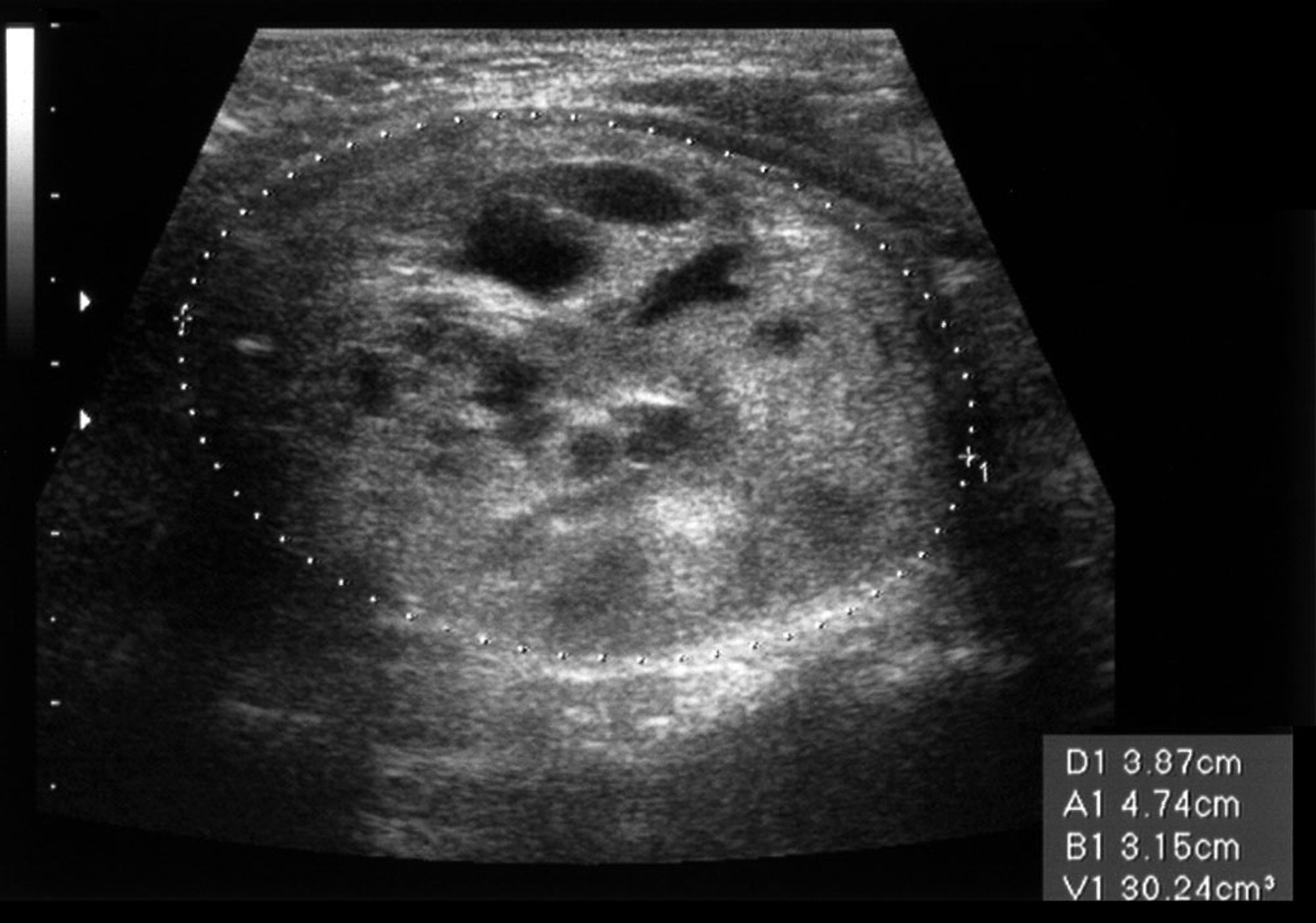 Thyroid Nodule (Ultrasound Scan)