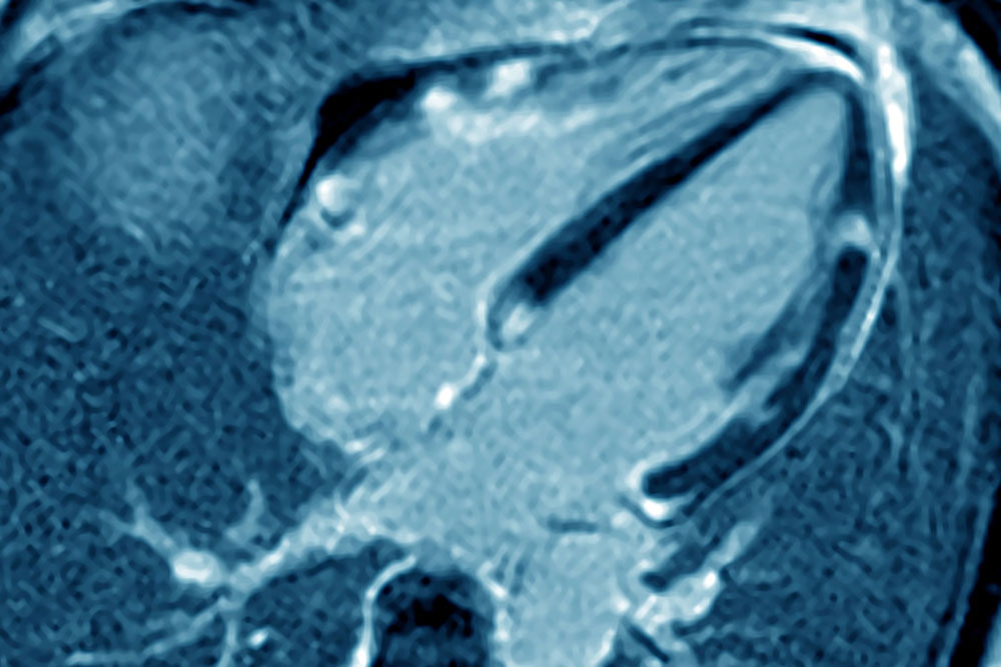Cardiac Sarcoidosis (MRI)