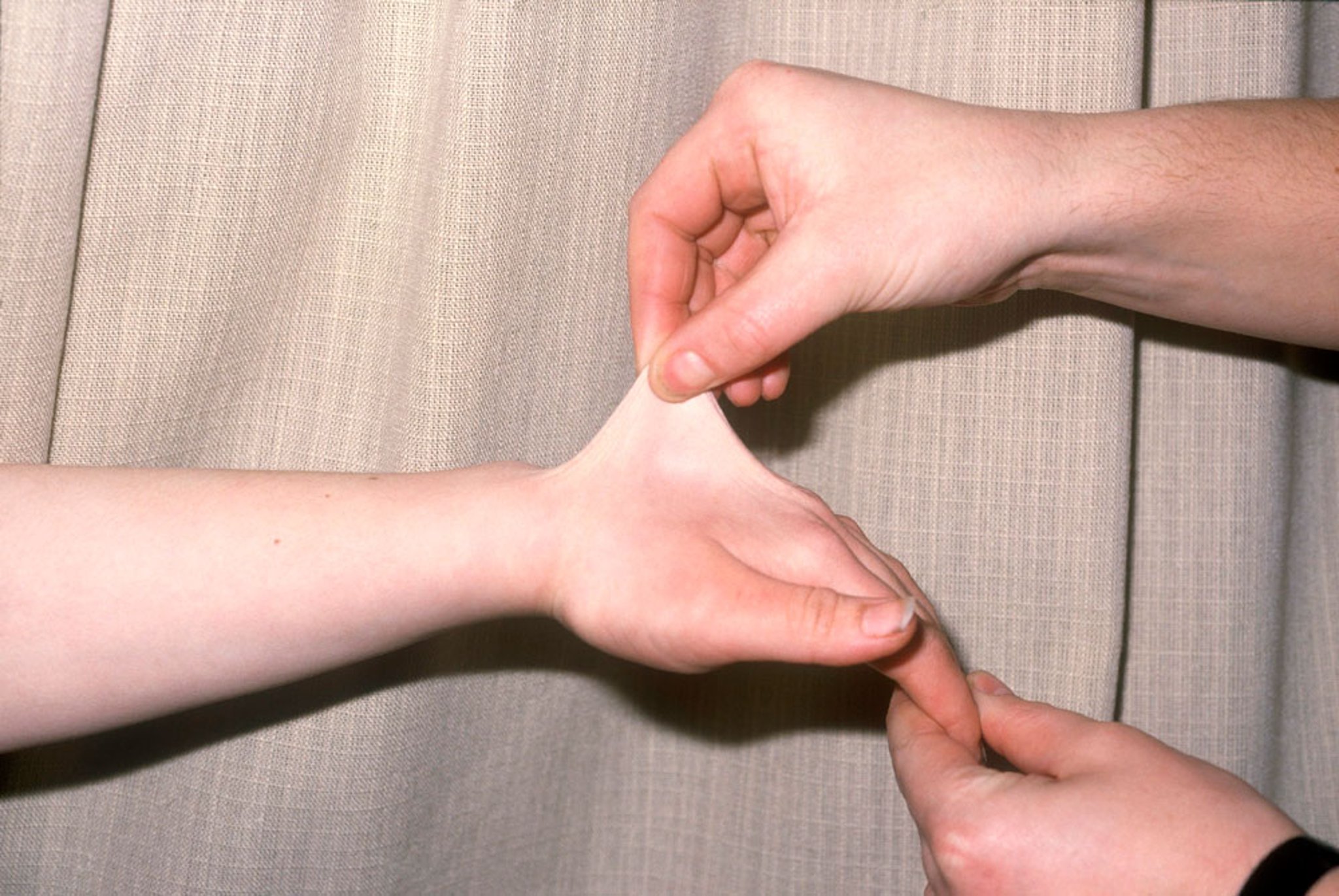 Skin Hyperelasticity in Ehlers-Danlos Syndromes