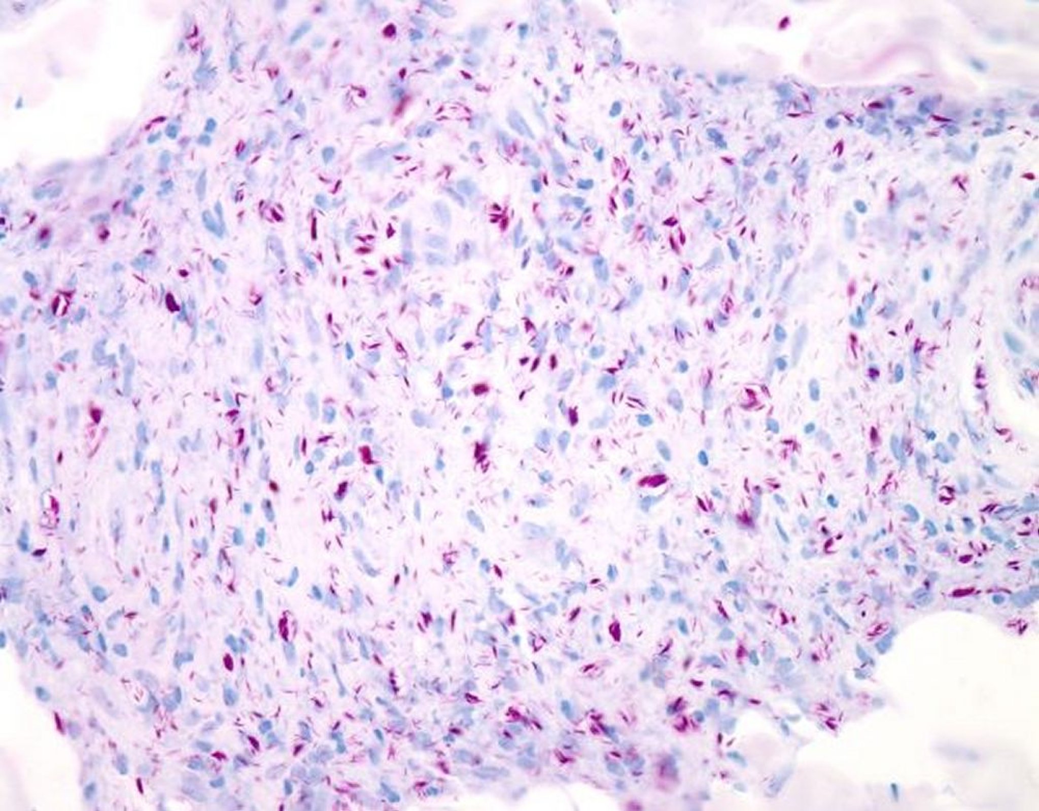 Ziehl-Neelsen-Färbung (<i >Mycobacterium leprae</i>)