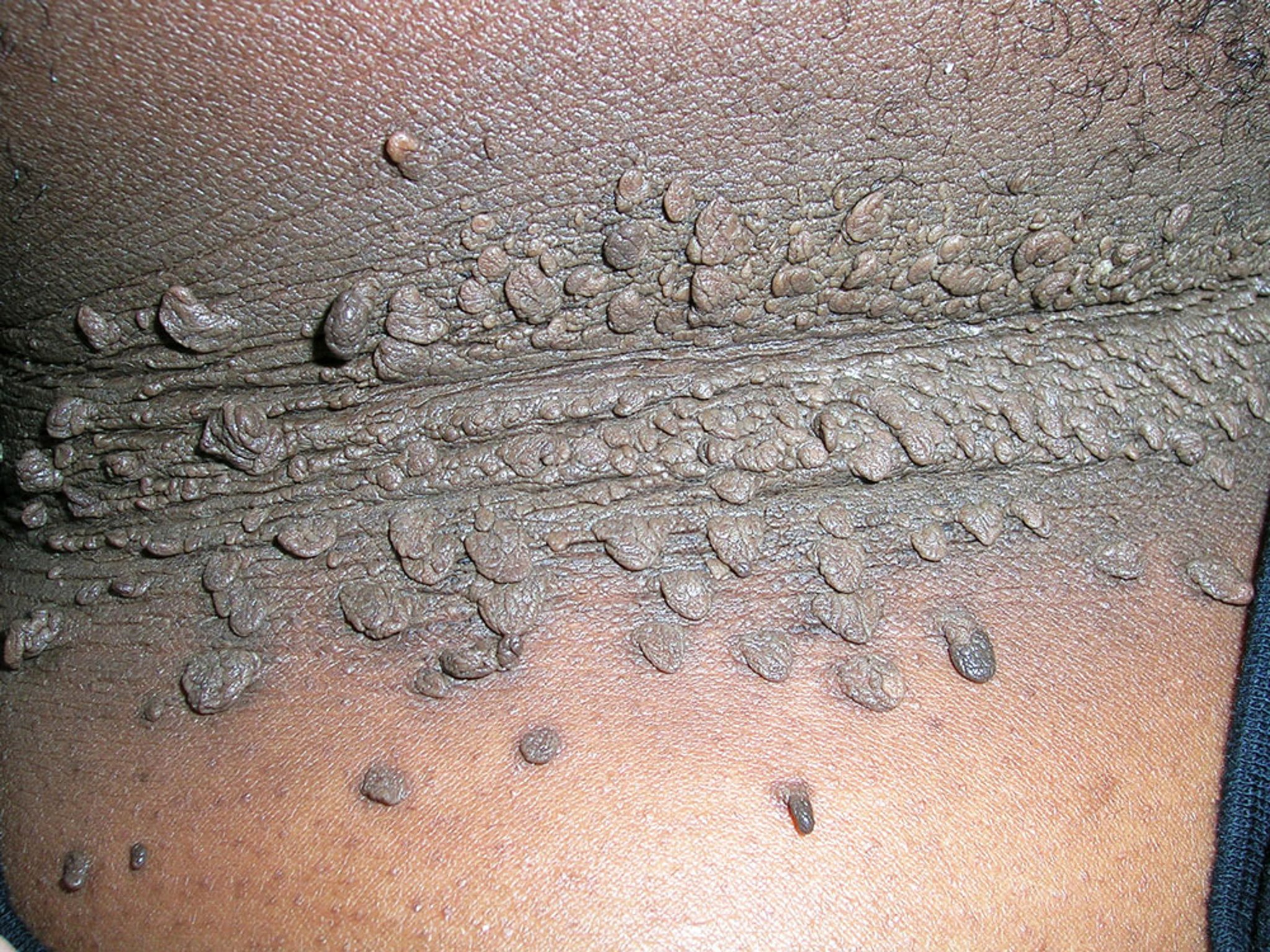 Acantosi nigricans (fibromi penduli)