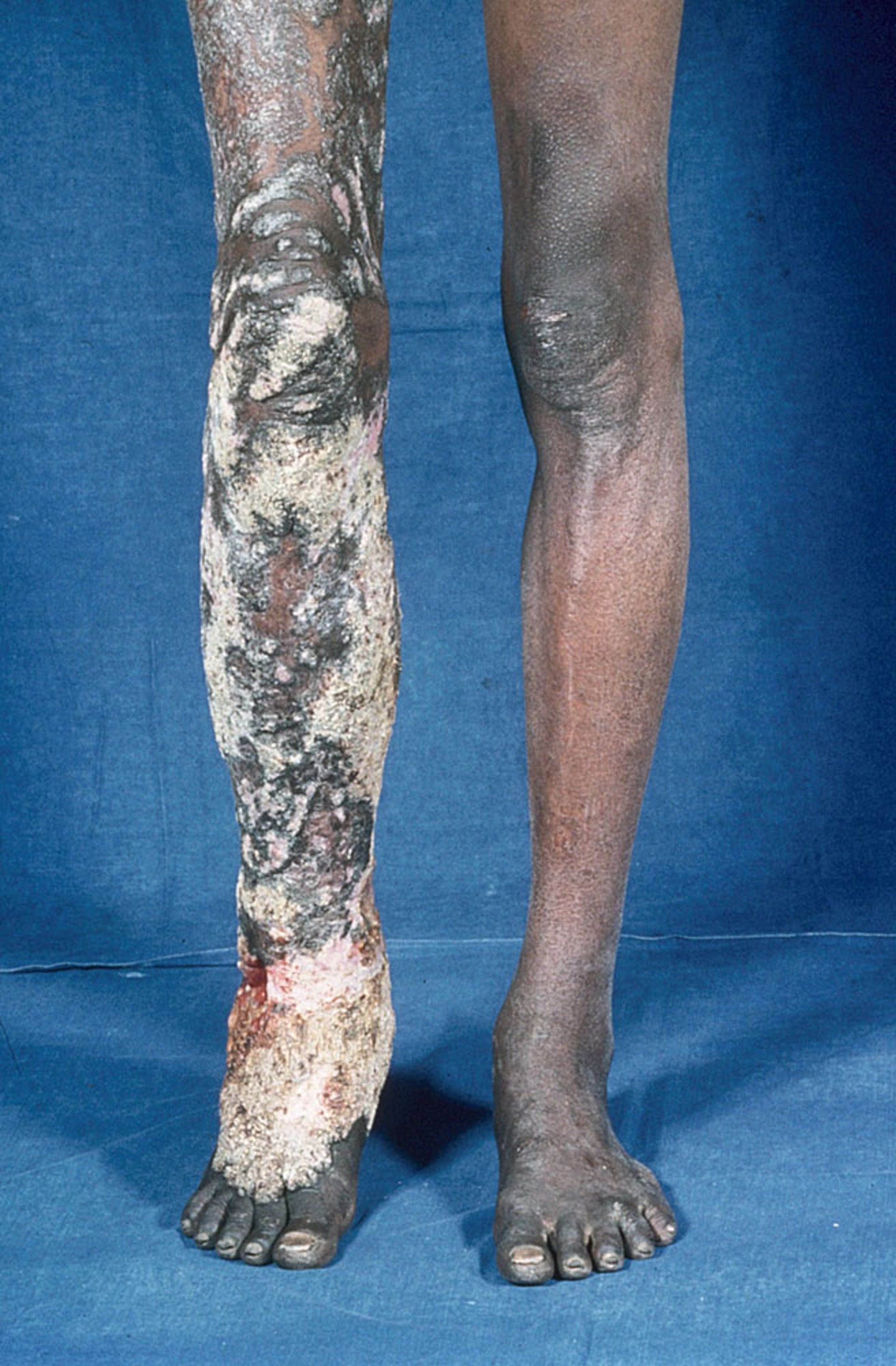 Cromoblastomicose (crônica) (3)