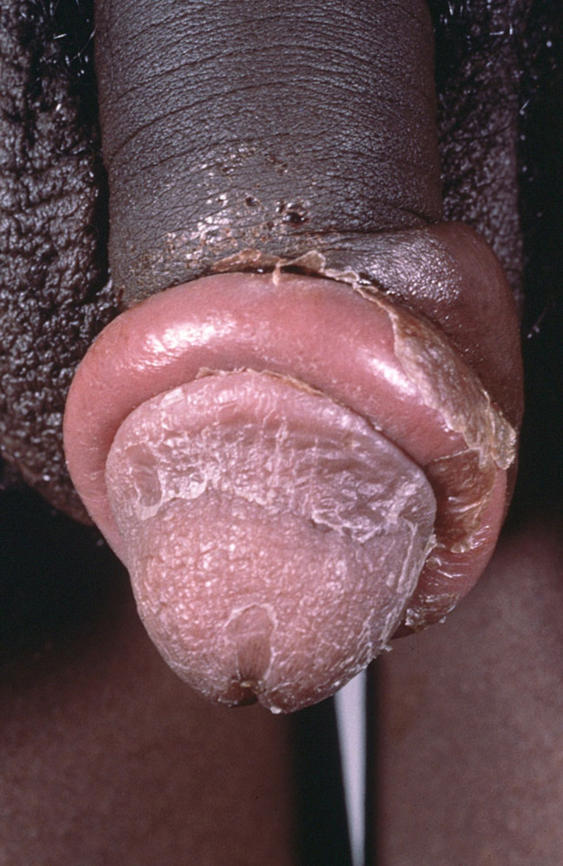 Parafimose (1)