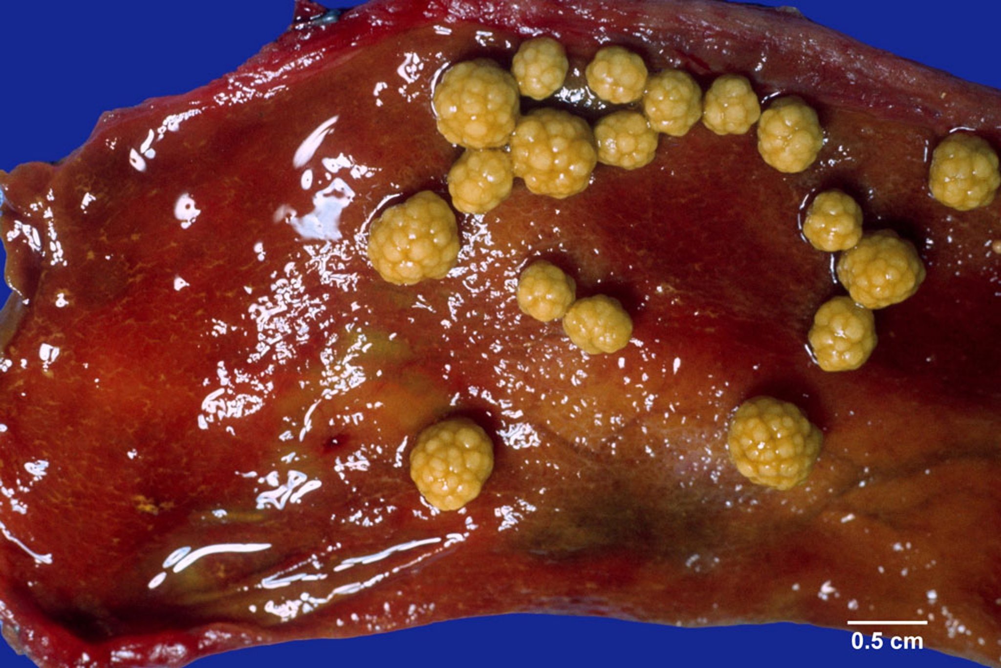 Cholesterol Stones