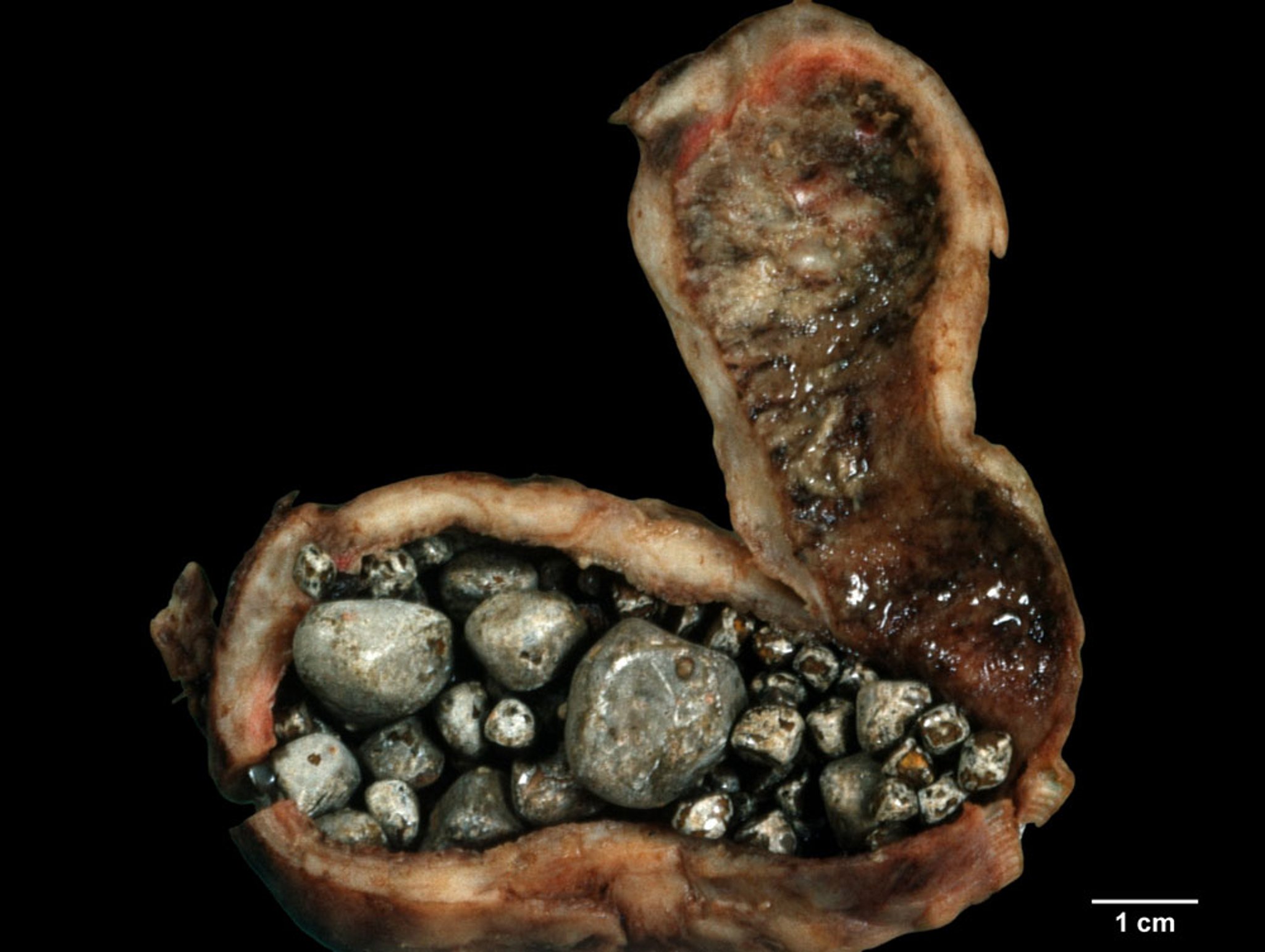 Cholesterinsteine gemischt mit Gallensalzen in einer entzündeten Gallenblase