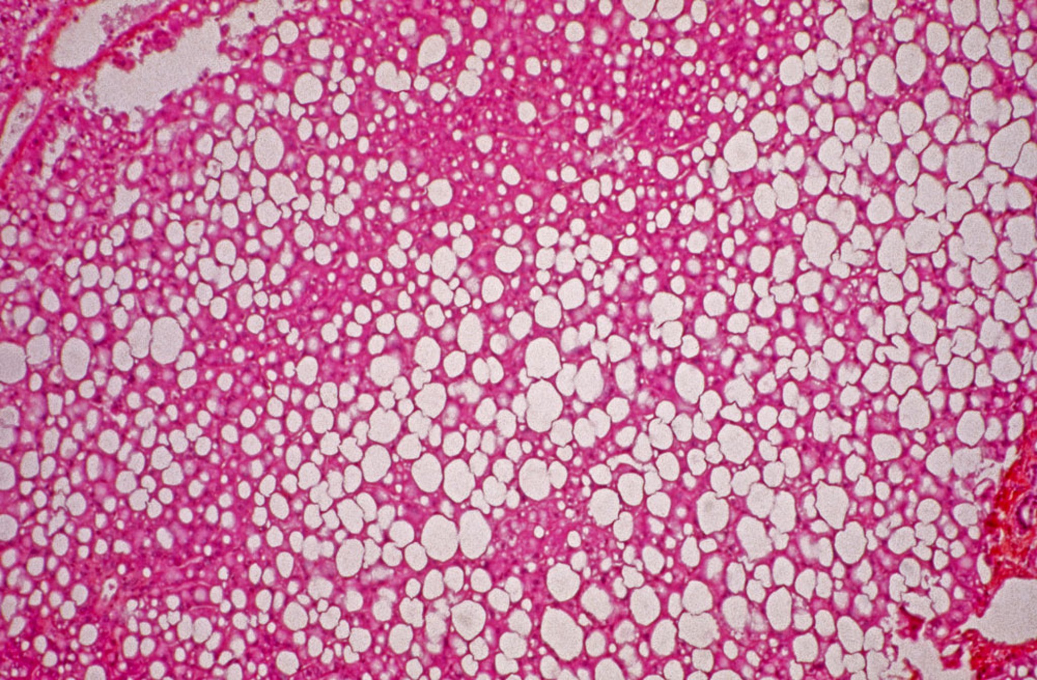 Esteatose hepática (microscopia óptica)