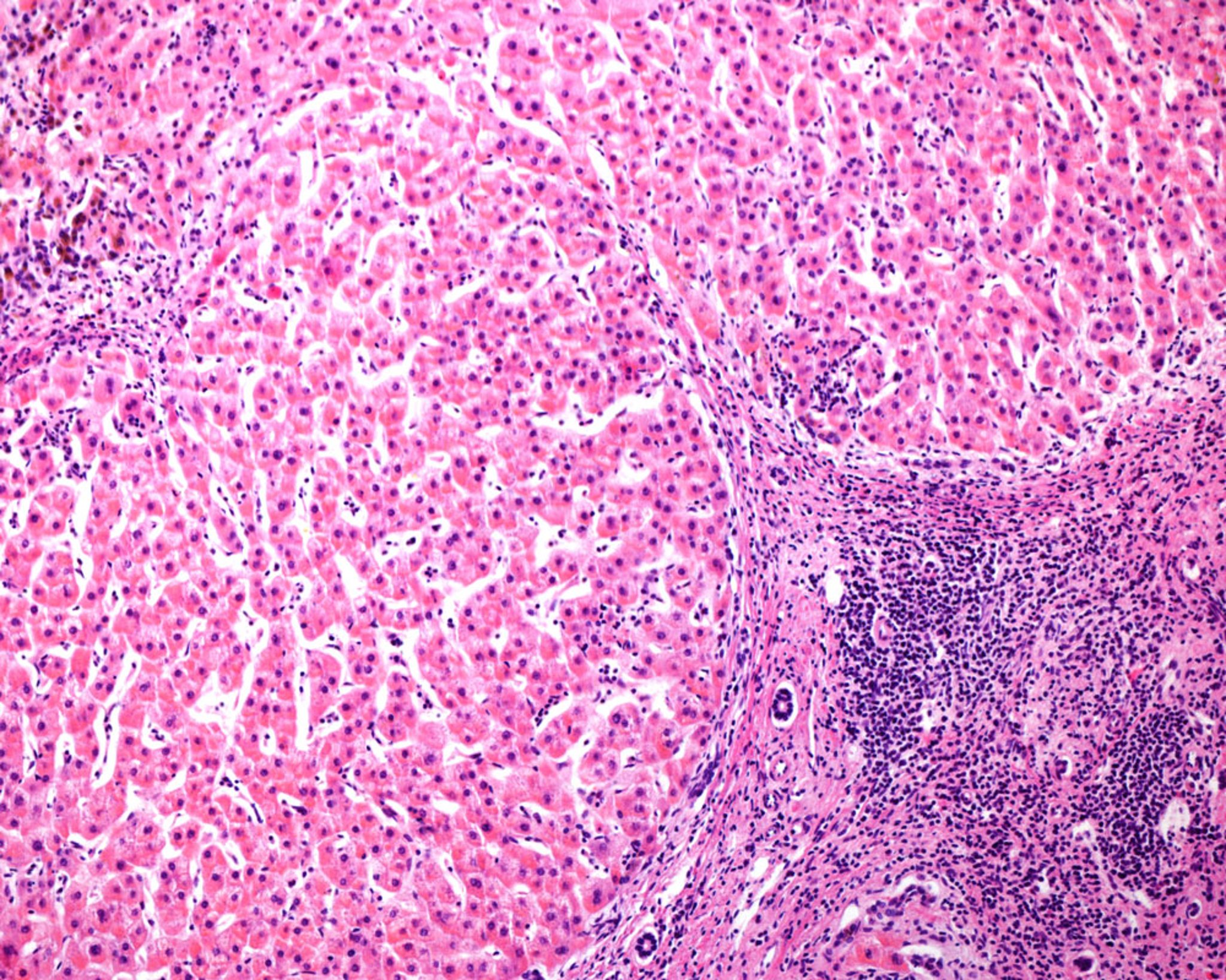 Cirrosi micronodulare nel fegato umano (micrografia ottica)