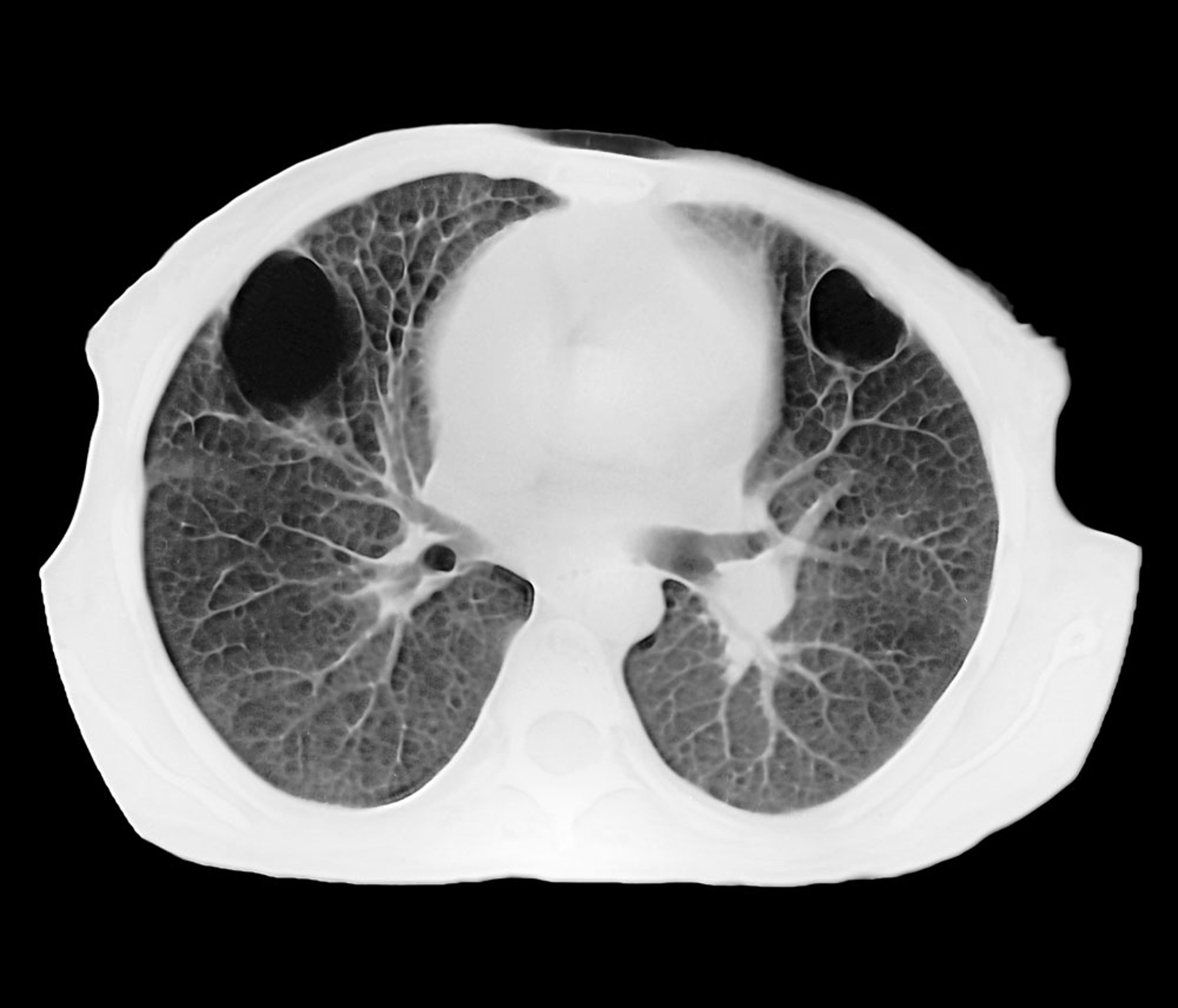 Lung Abscess (CT Scan)