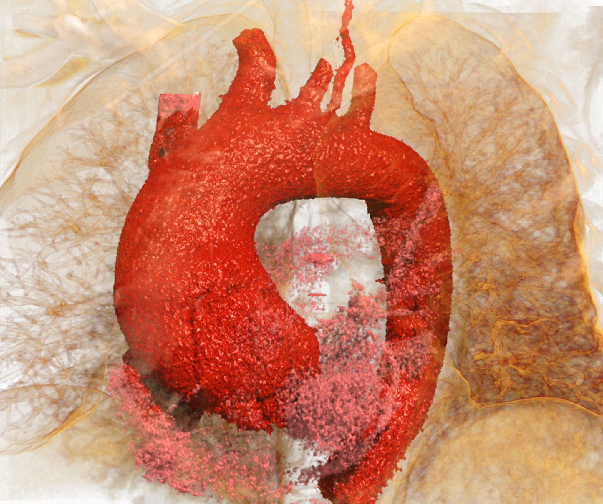 Aortic Aneurysm with Dissection