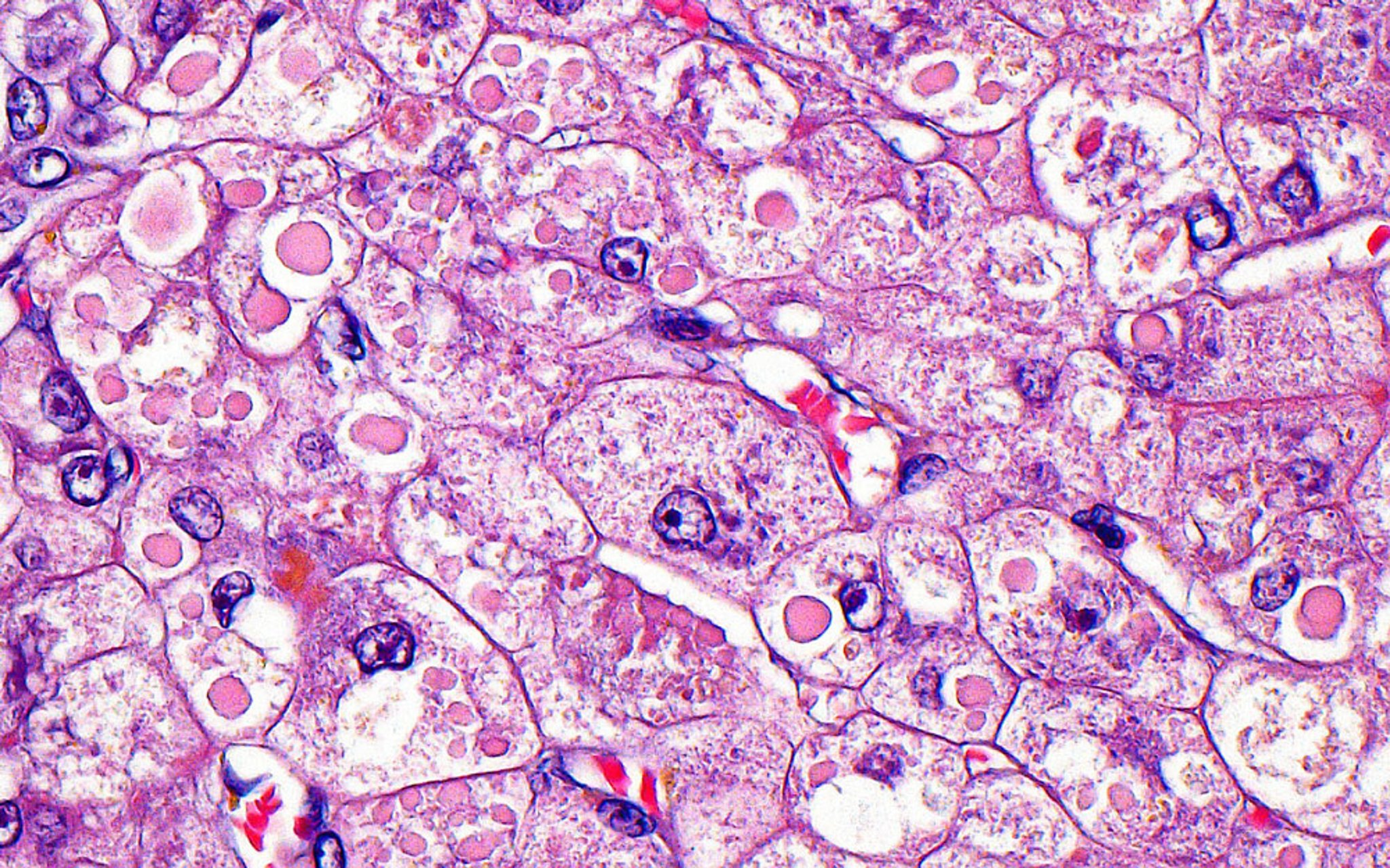 Alpha-1 Antitrypsin Deficiency (Light Micrograph)