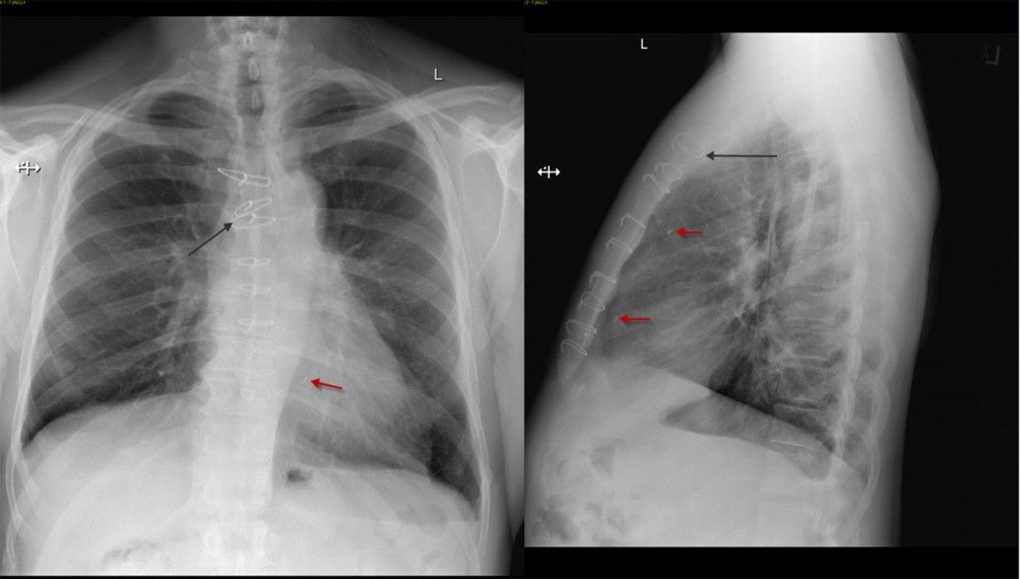 Chest X-Ray of a Patient After Coronary Artery Bypass Surgery