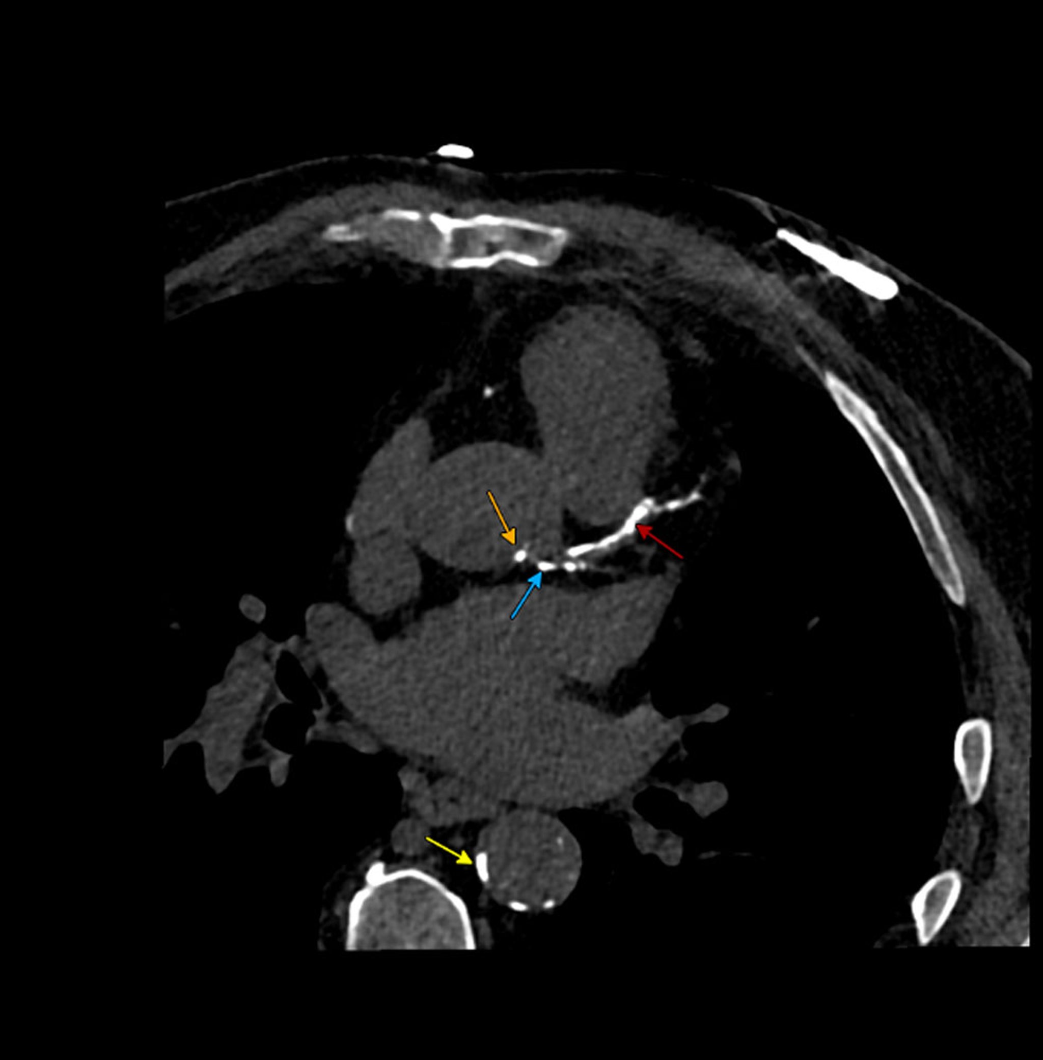 Calcified Atherosclerosis on Calcium Scoring Computed Tomography (CT) Scan
