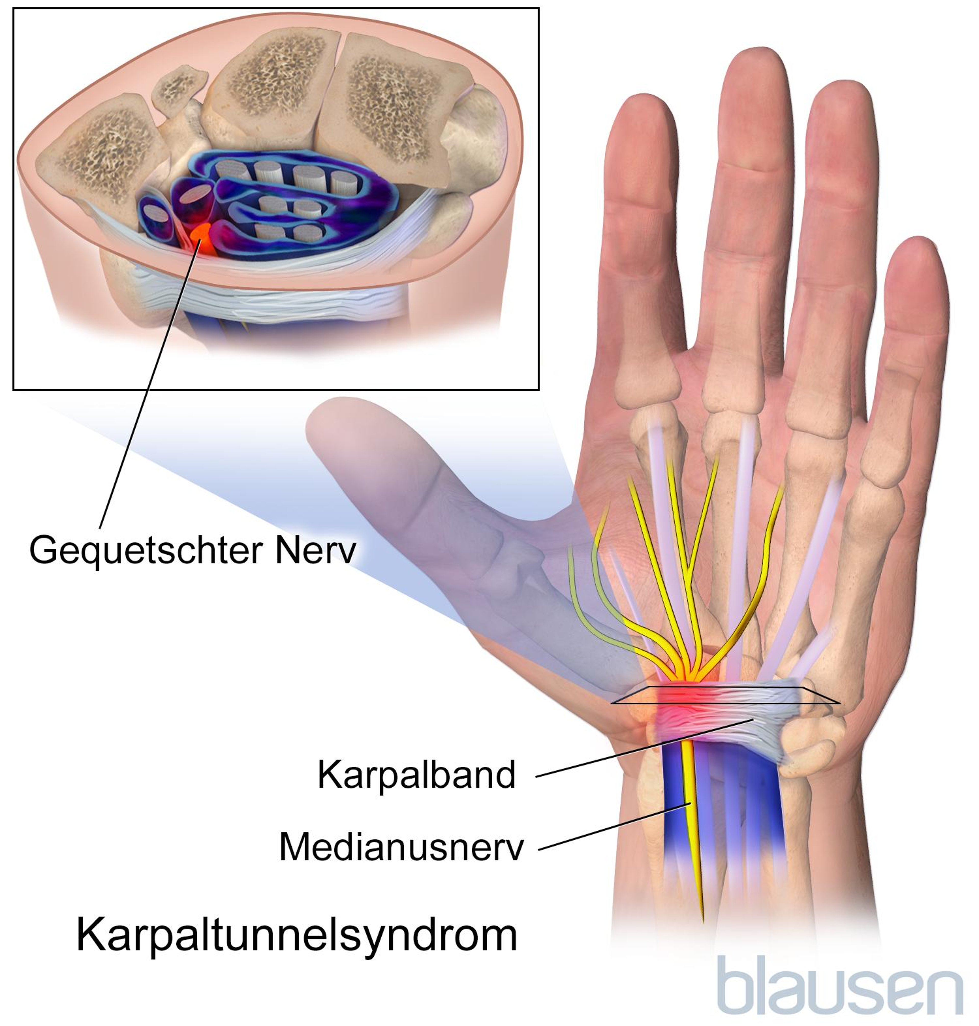 Karpaltunnelsyndrom