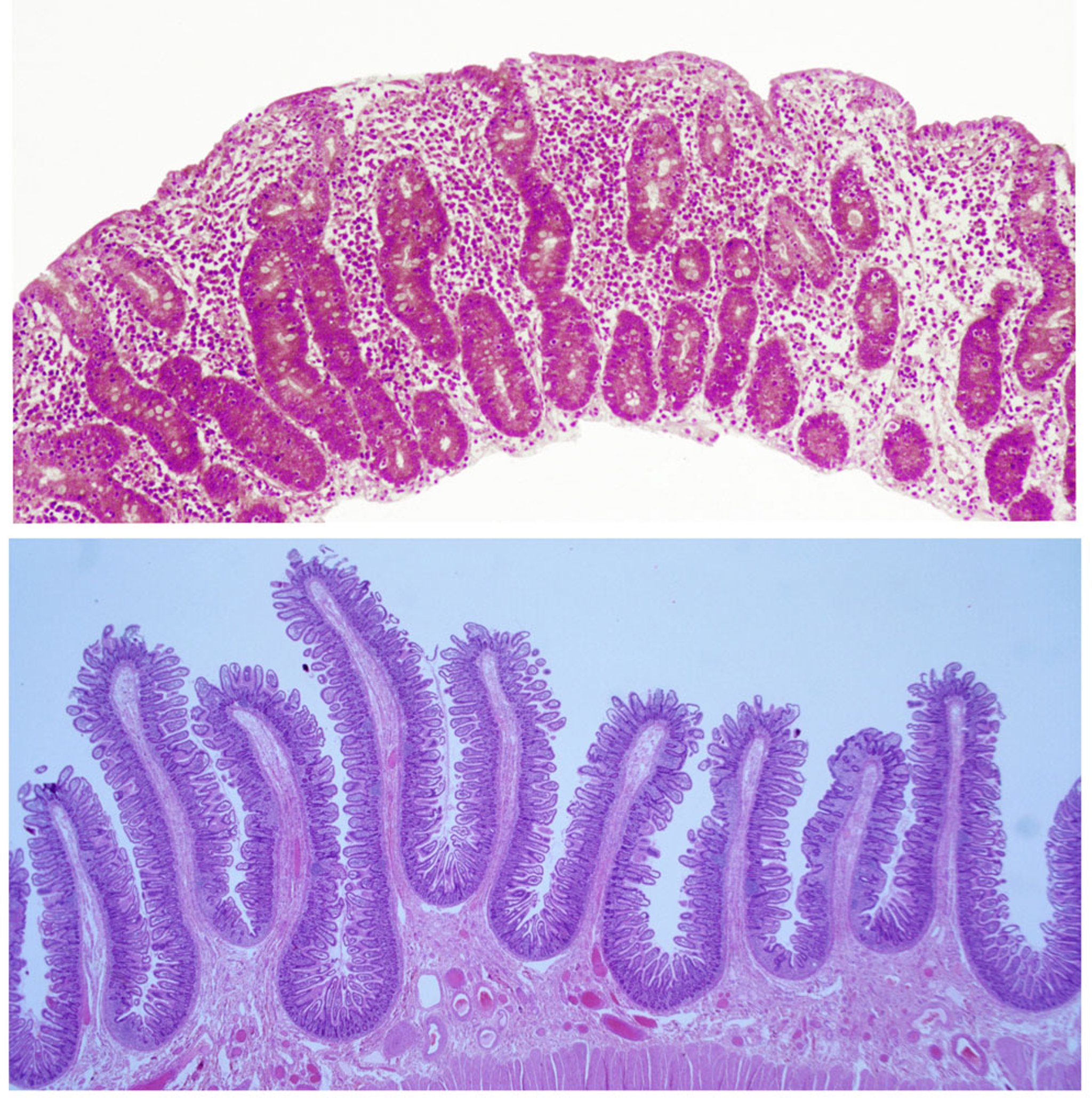 Intestino anormal y normal (microscopia)