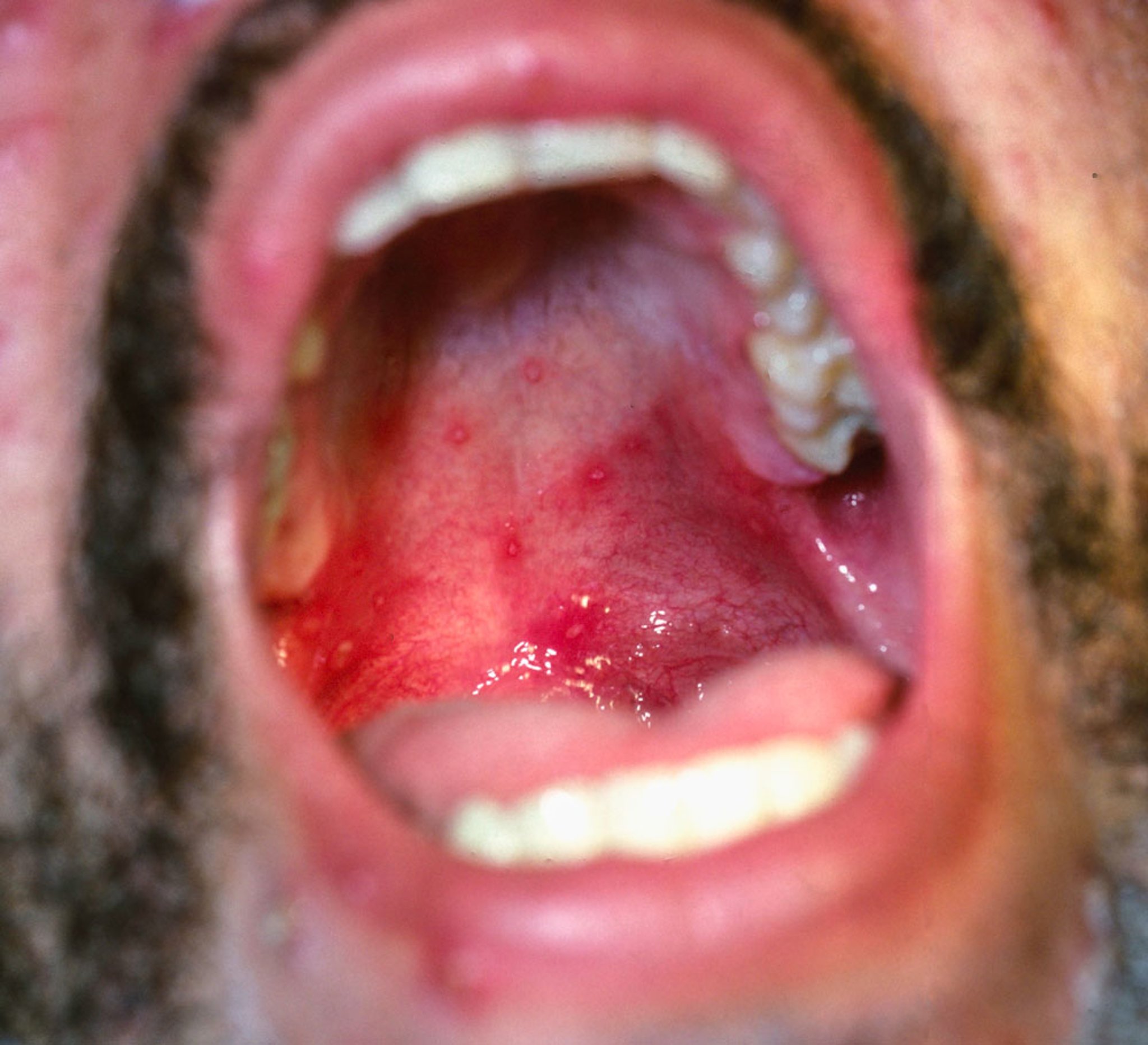 Chickenpox (Mouth)