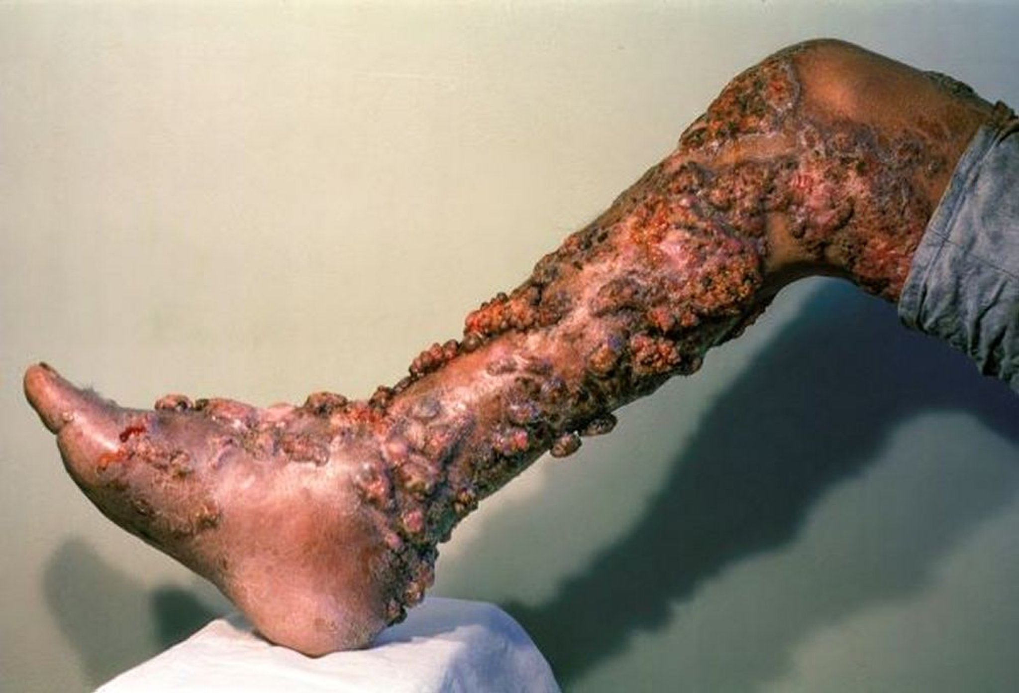 Chromoblastomycosis (Chronic) (2)