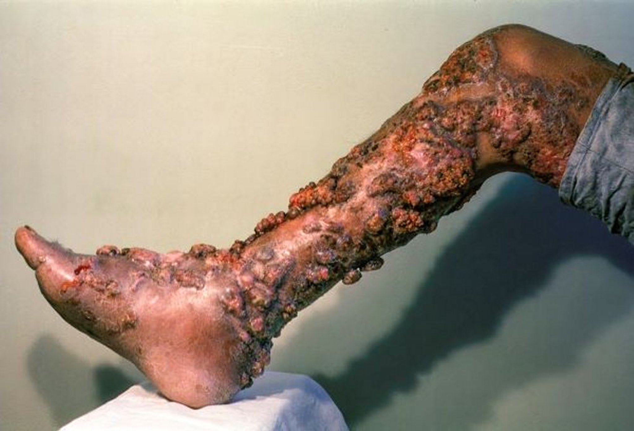 Chromoblastomycosis