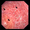 Chronic Gastritis