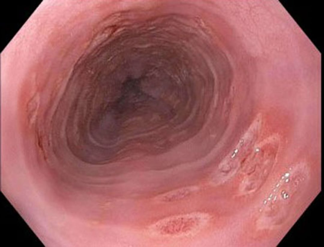 Herpes Simplex Esophagitis