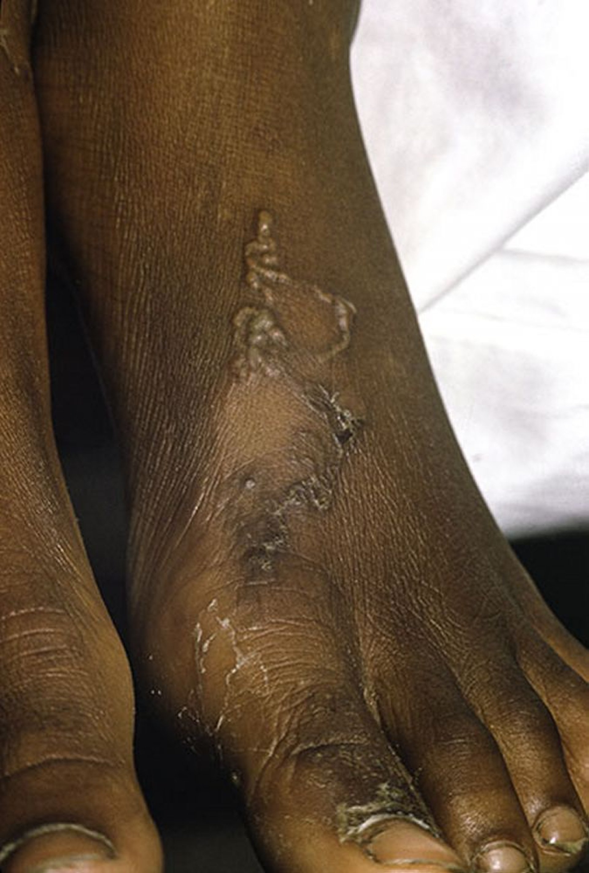 Мигрирующая кожная личинка (2)