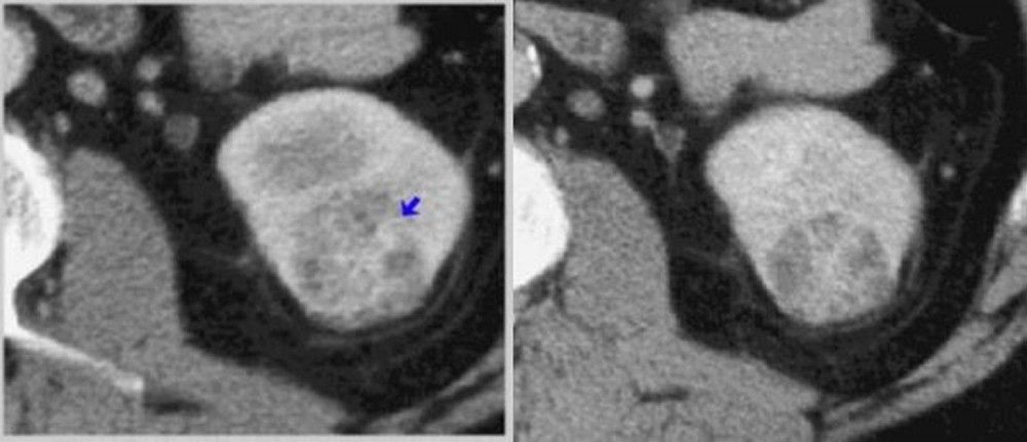 TC con contrasto del rene (fasi corticomedollari e nefrogene)