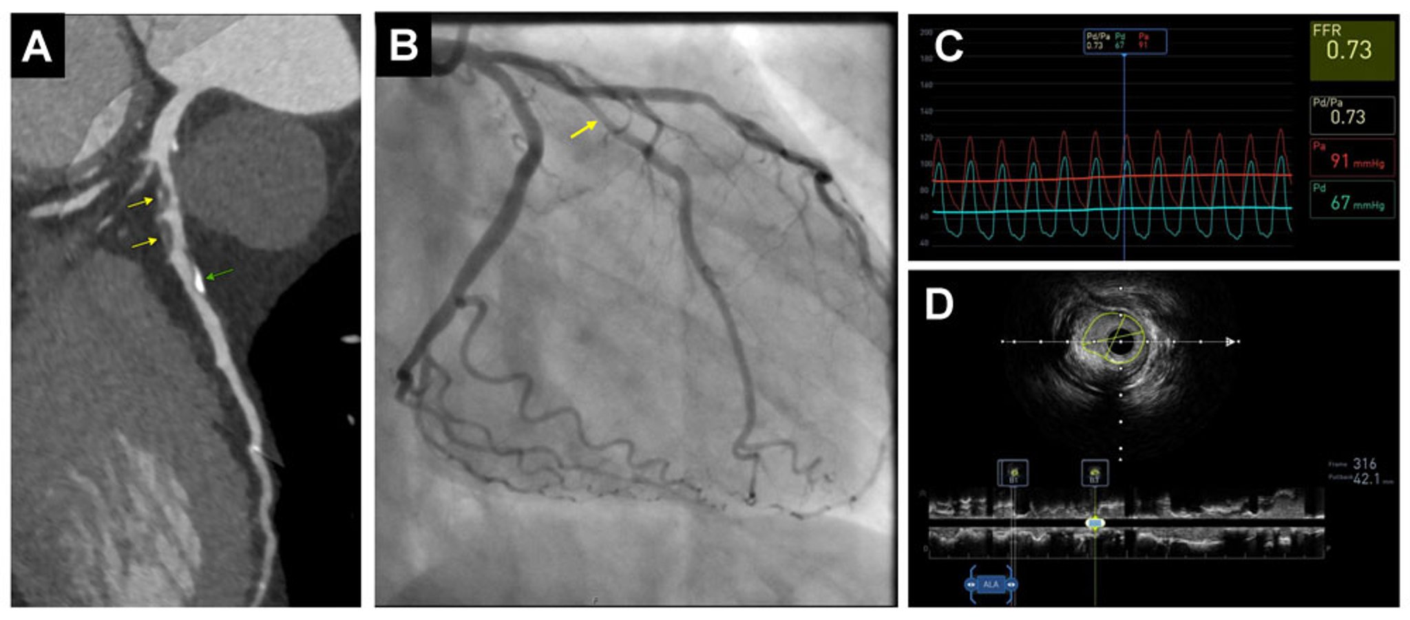 Coronary Atherosclerosis (Diagnostic Tests)