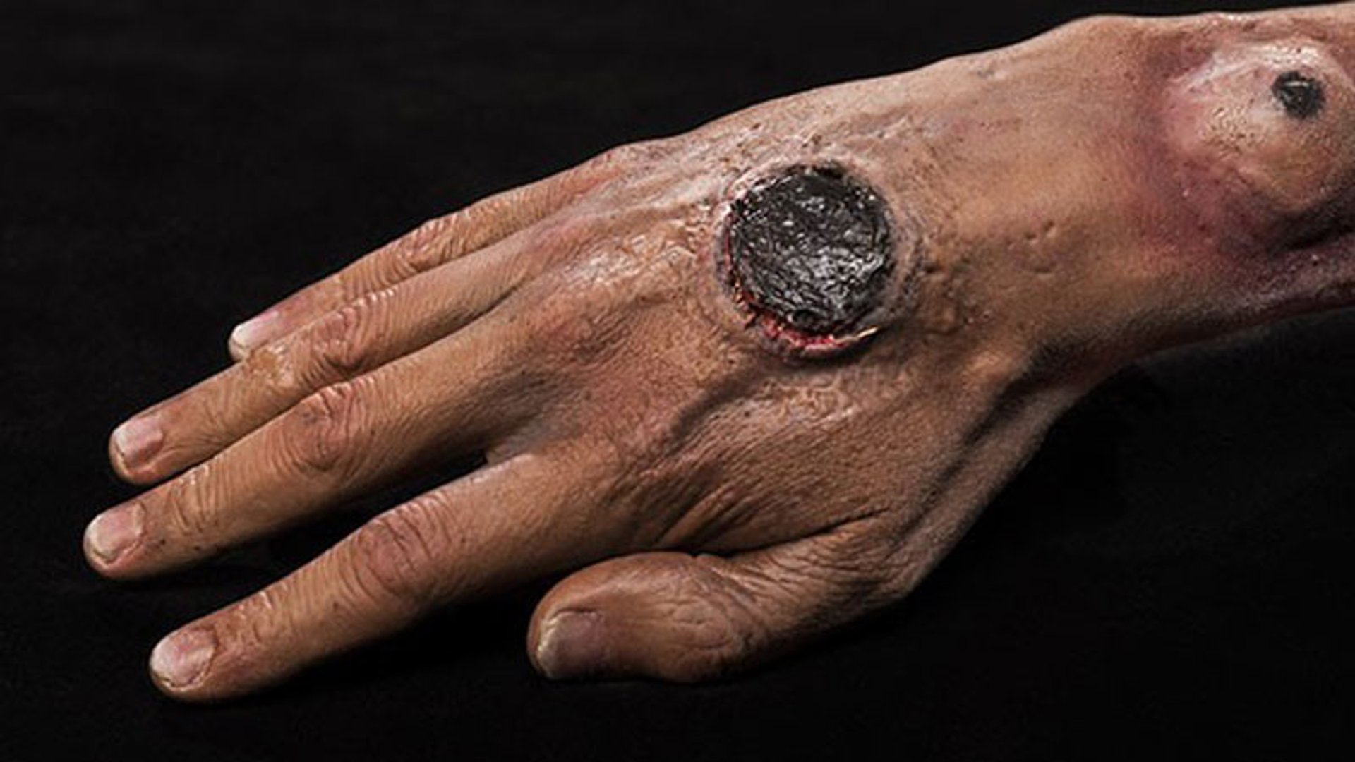 Cutaneous Anthrax (Eschar)