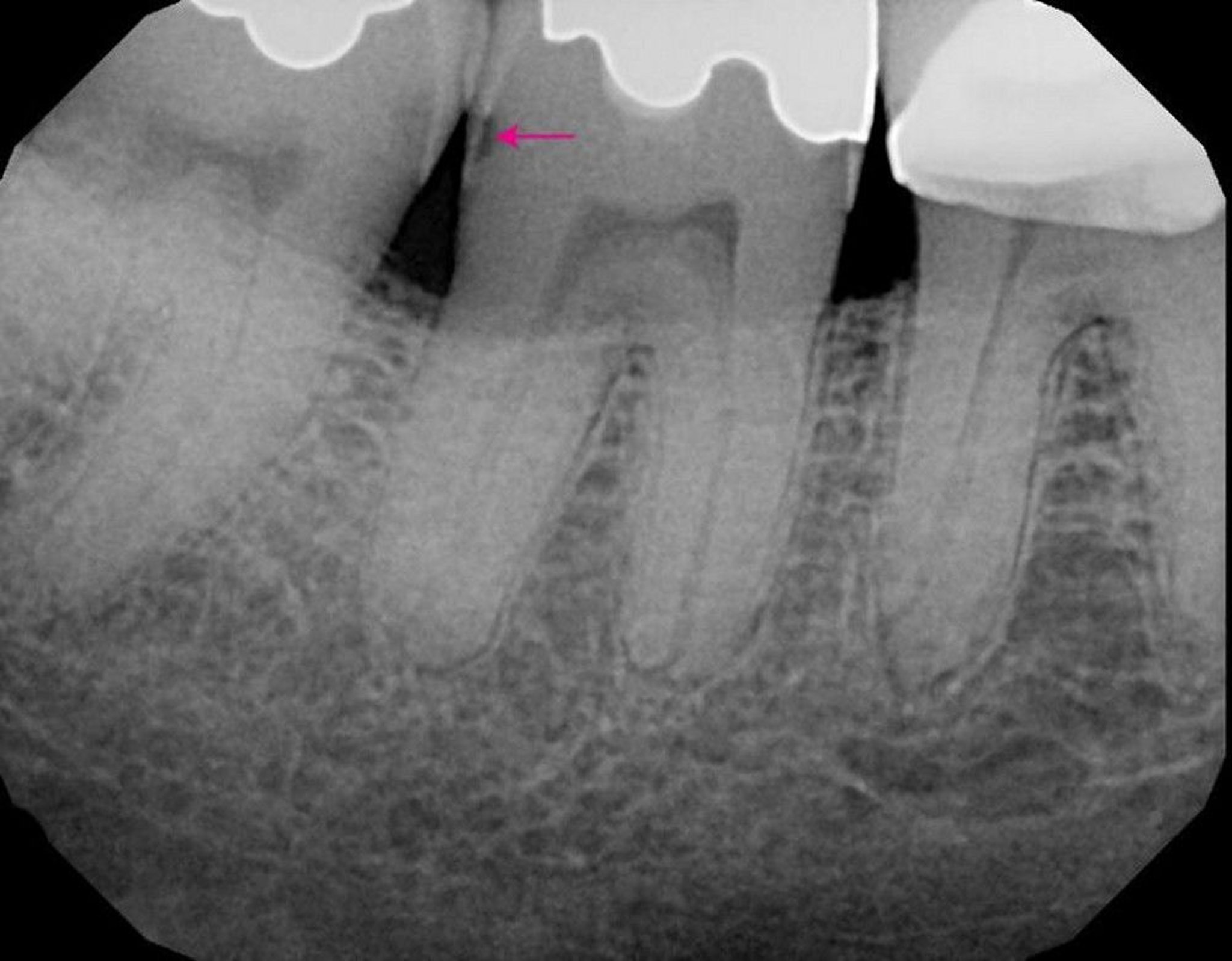 Caries (on X-Ray)