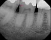 Caries (Radiograph)