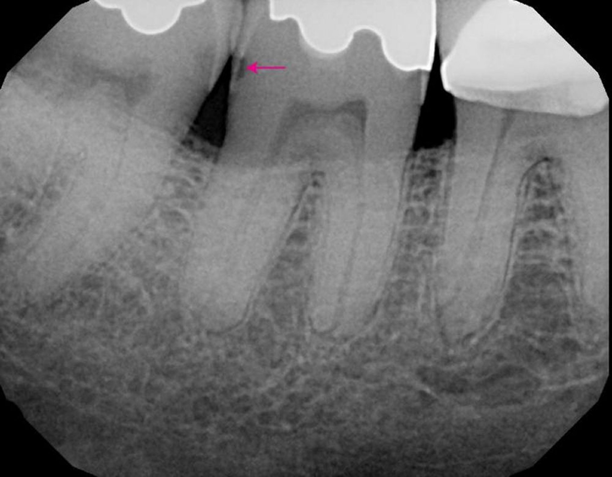 Sâu răng (trên X-quang)