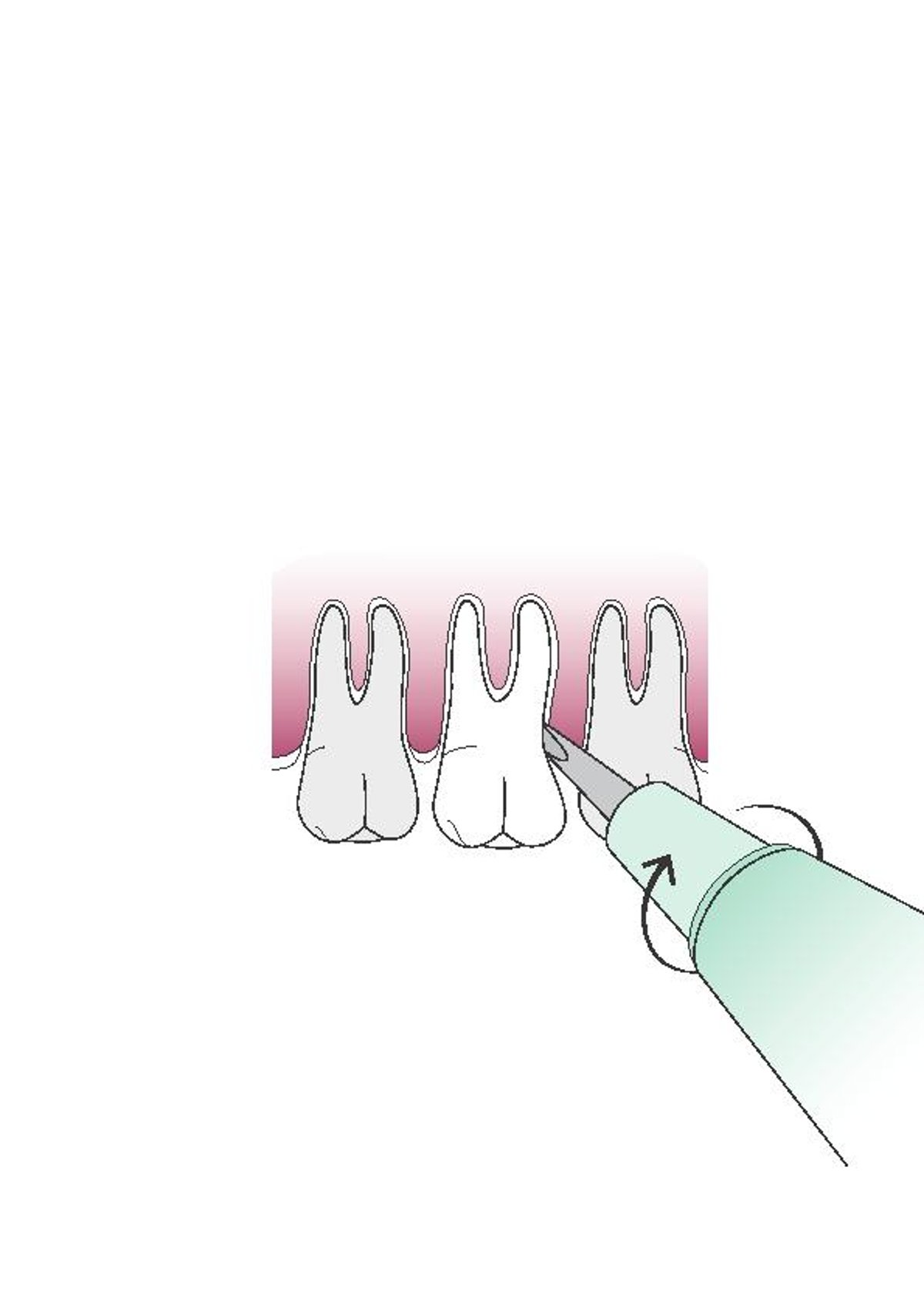 Verwendung eines Zahnhebers