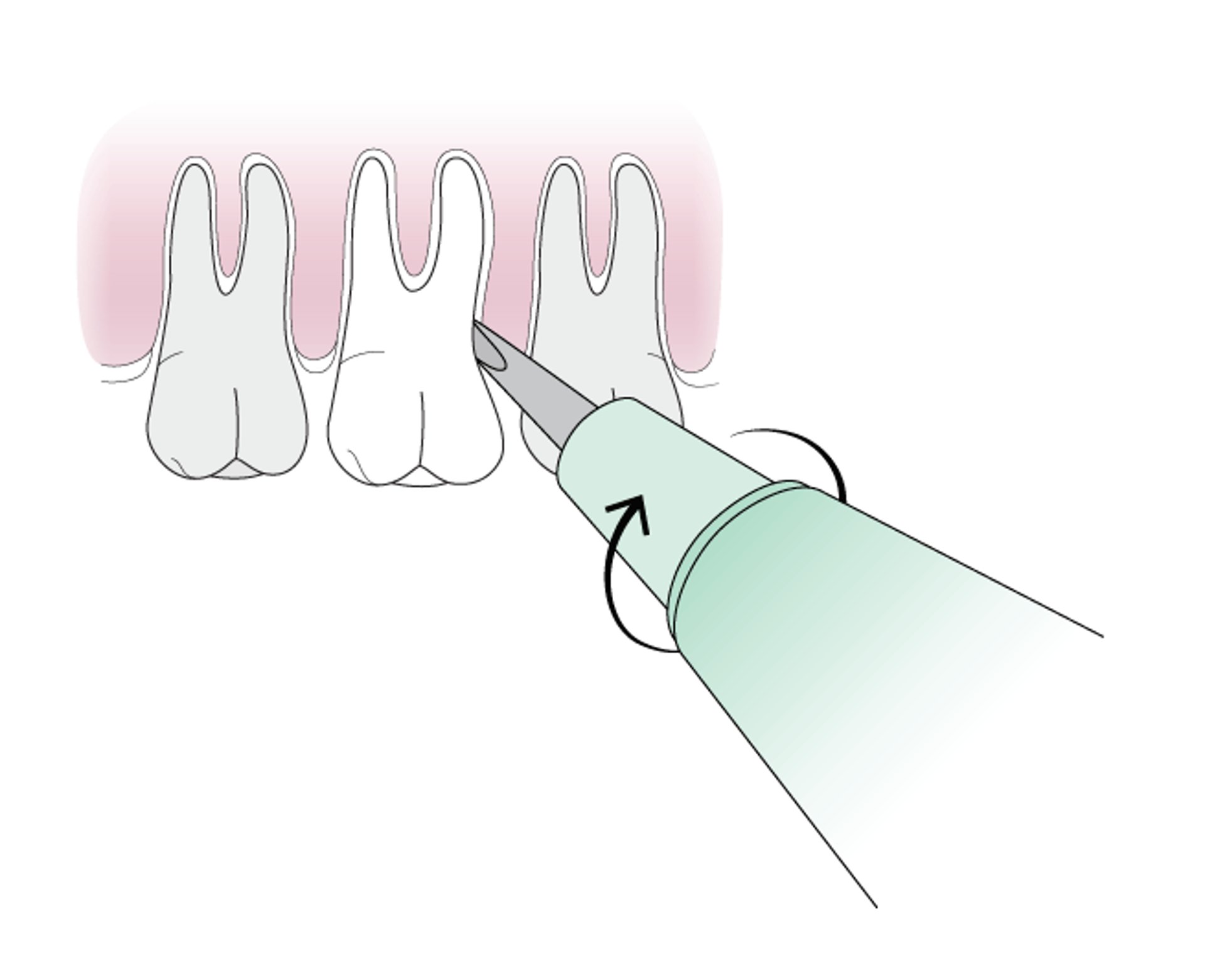 Uso del elevador dental