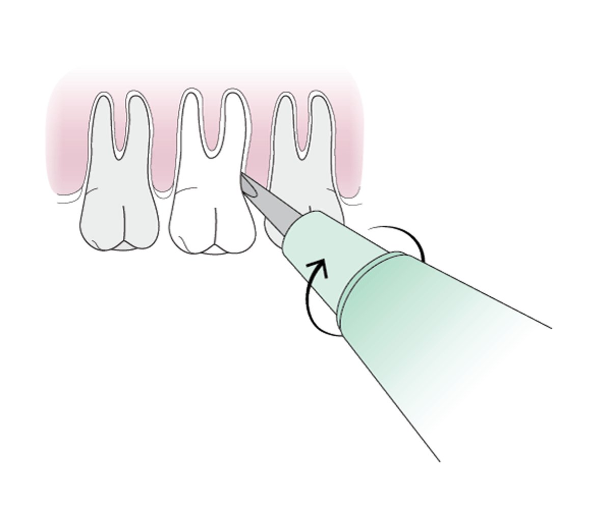 Uso de elevador odontológico