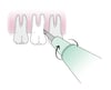 Sử dụng dụng cụ nâng răng nha khoa