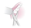 Use of Dental Forceps