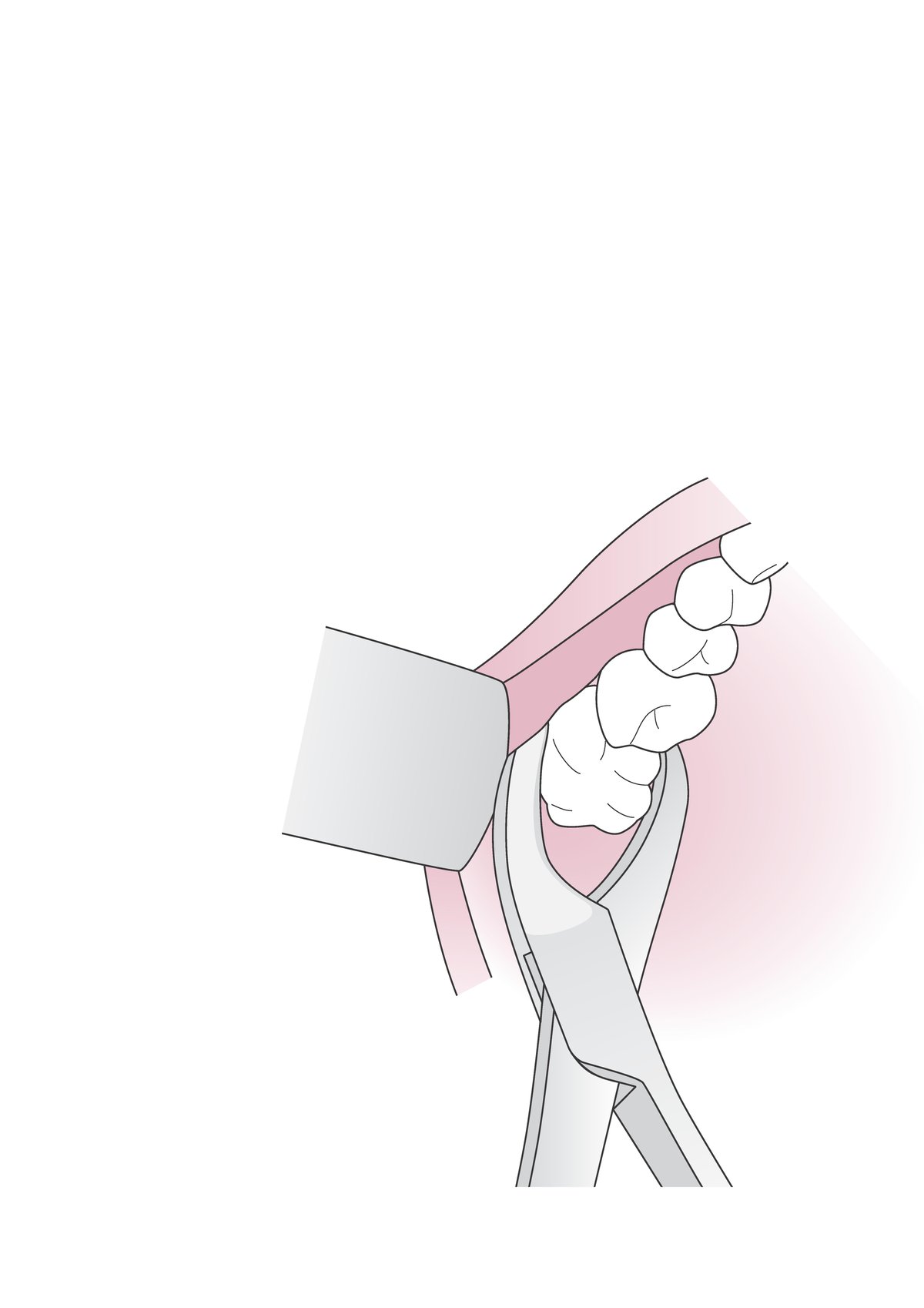 Uso di una pinza odontoiatrica