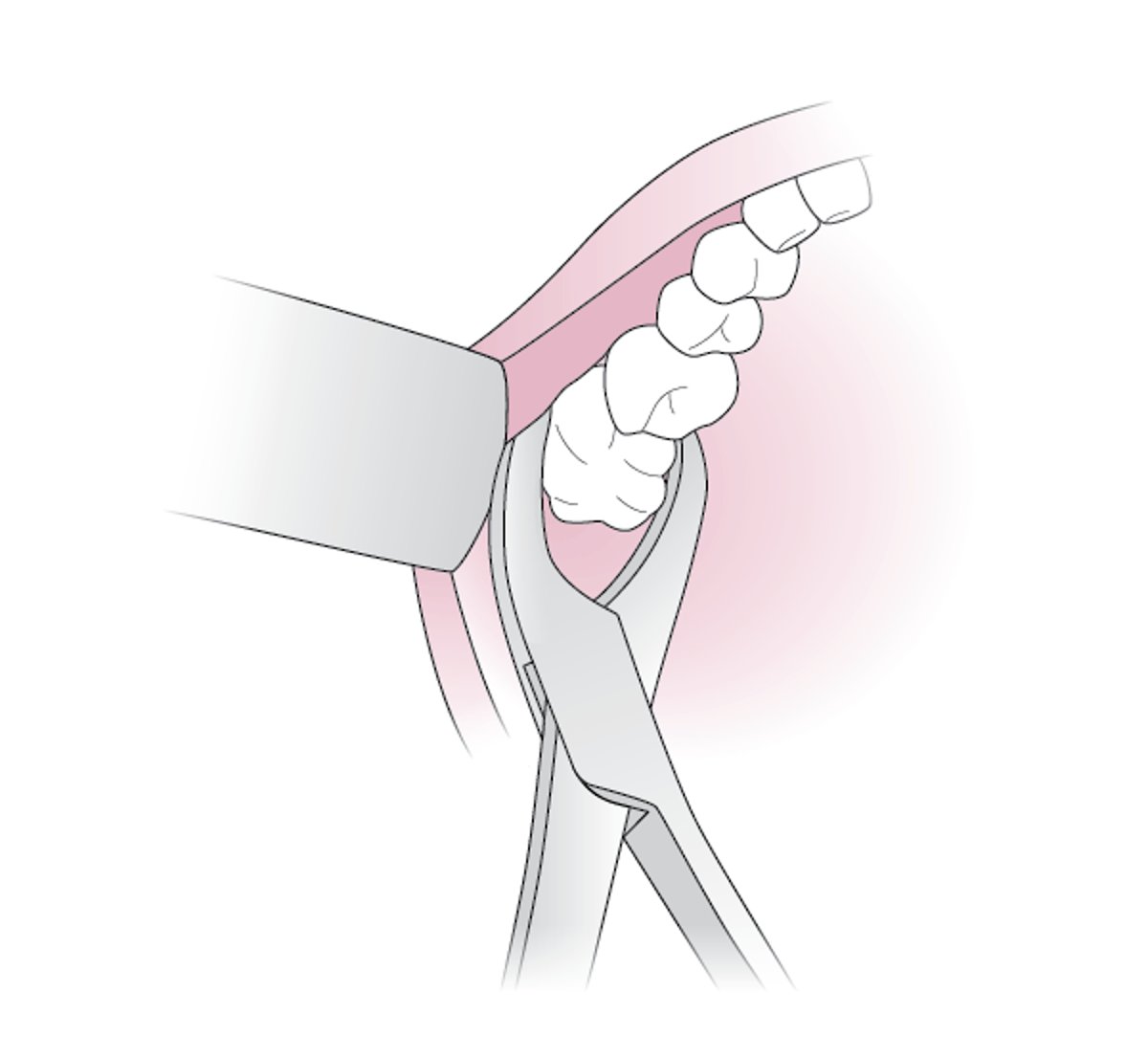 Uso de fórceps odontológico
