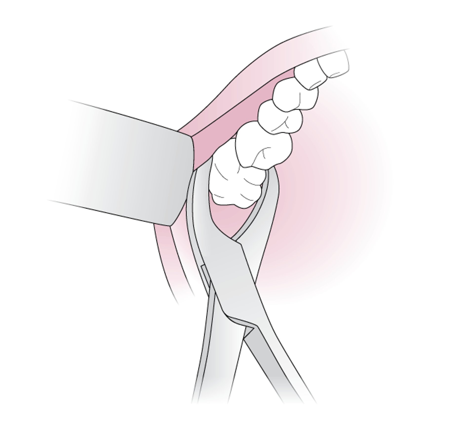 Sử dụng kẹp răng