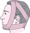 Barton's bandage