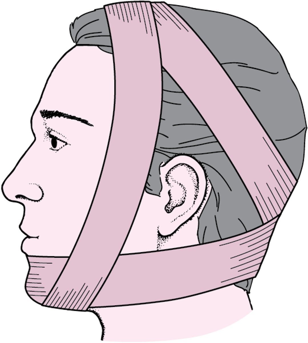 Bandage de Barton