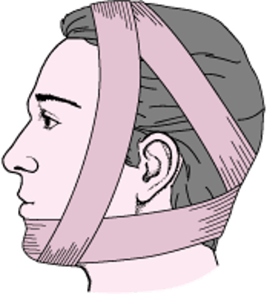 бандаж Бартона