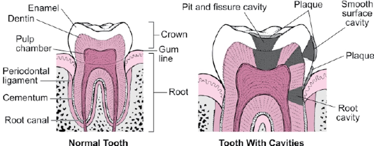 Types of Cavities
