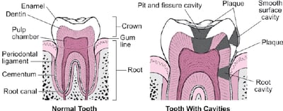 Types of Cavities